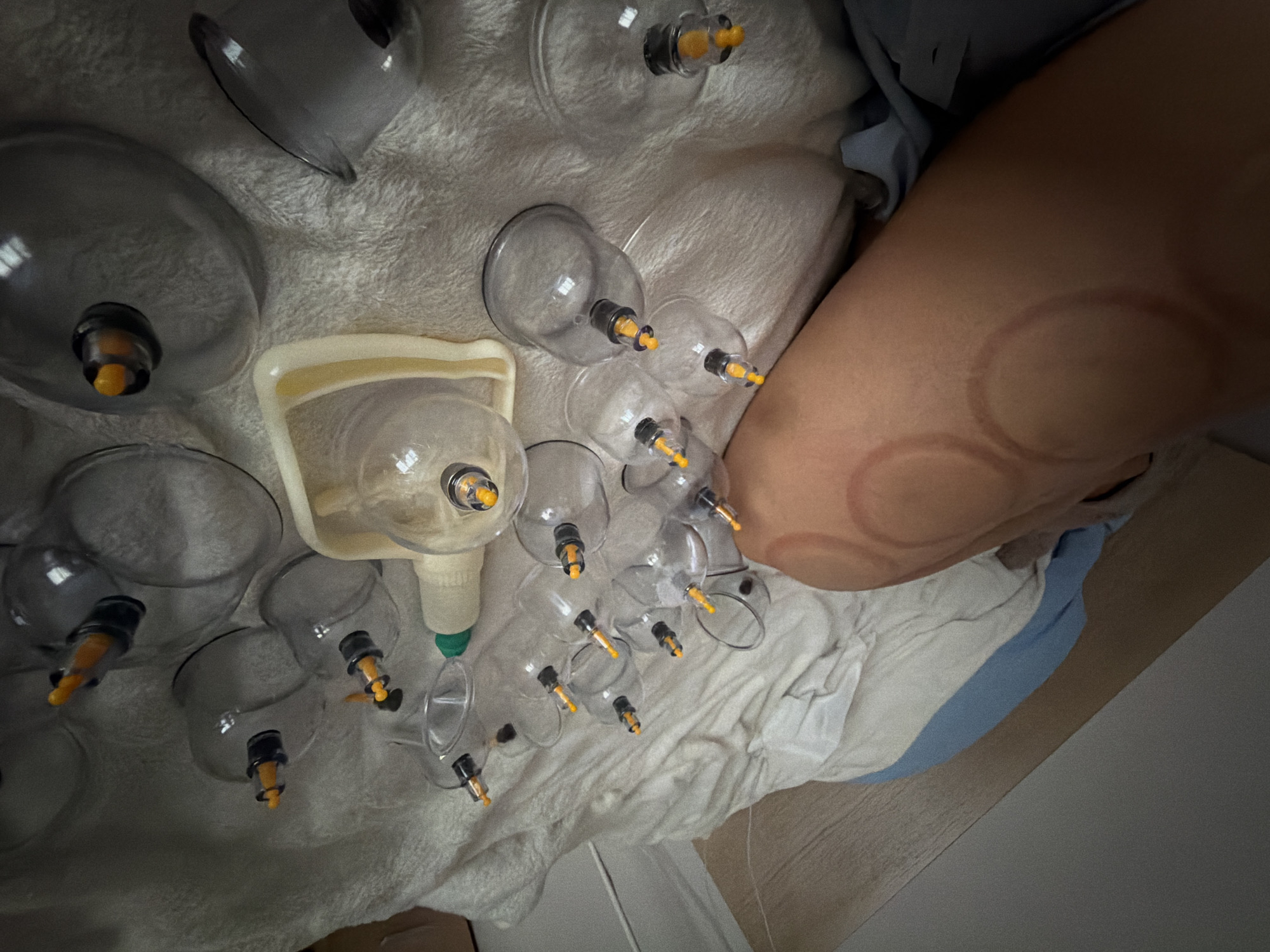 The image shows a collection of clear plastic cupping tools with orange plungers arranged on a white, textured surface, possibly a towel or blanket. One tool is housed within a pale yellow tray. To the right of the tools is a portion of a person's arm or leg bearing circular red marks indicative of cupping therapy. The setting and location are unknown.