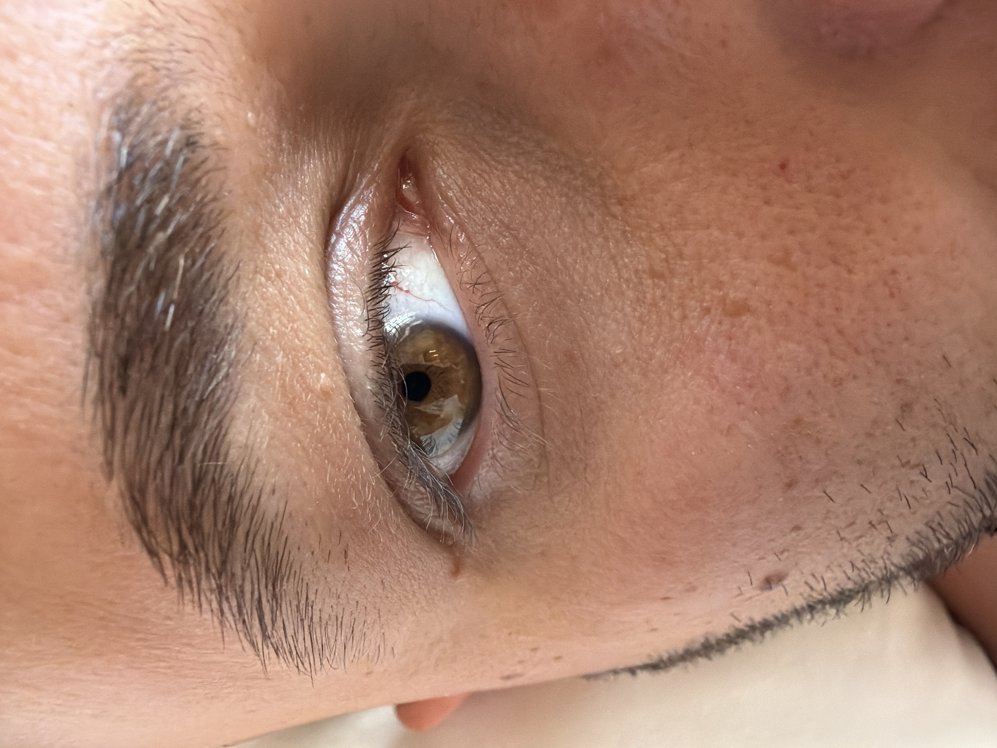 This is a close-up, eye-level, medium shot of a person's right eye and surrounding facial features, taken indoors, likely in a private residence. The subject is a person with light to medium-toned skin. Their right eye is open, with a brown iris and visible blood vessels in the white of the eye. The eyelashes are dark and appear somewhat sparse. The eyebrow above the eye is dark and full, with some lighter, possibly gray, hairs interspersed. The skin shows some pores and what appear to be small freckles or sunspots. There is a small mole or birthmark on the cheekbone area just below the eye. A slight stubble of dark facial hair is visible along the jawline. The background consists of a soft, pale, out-of-focus surface, possibly bedding or clothing, suggesting the person may be lying down or reclining. No specific landmarks or environmental details are visible that would indicate the location in Kassandra Municipal Unit, Greece. The lighting is even, illuminating the subject's face without harsh shadows.