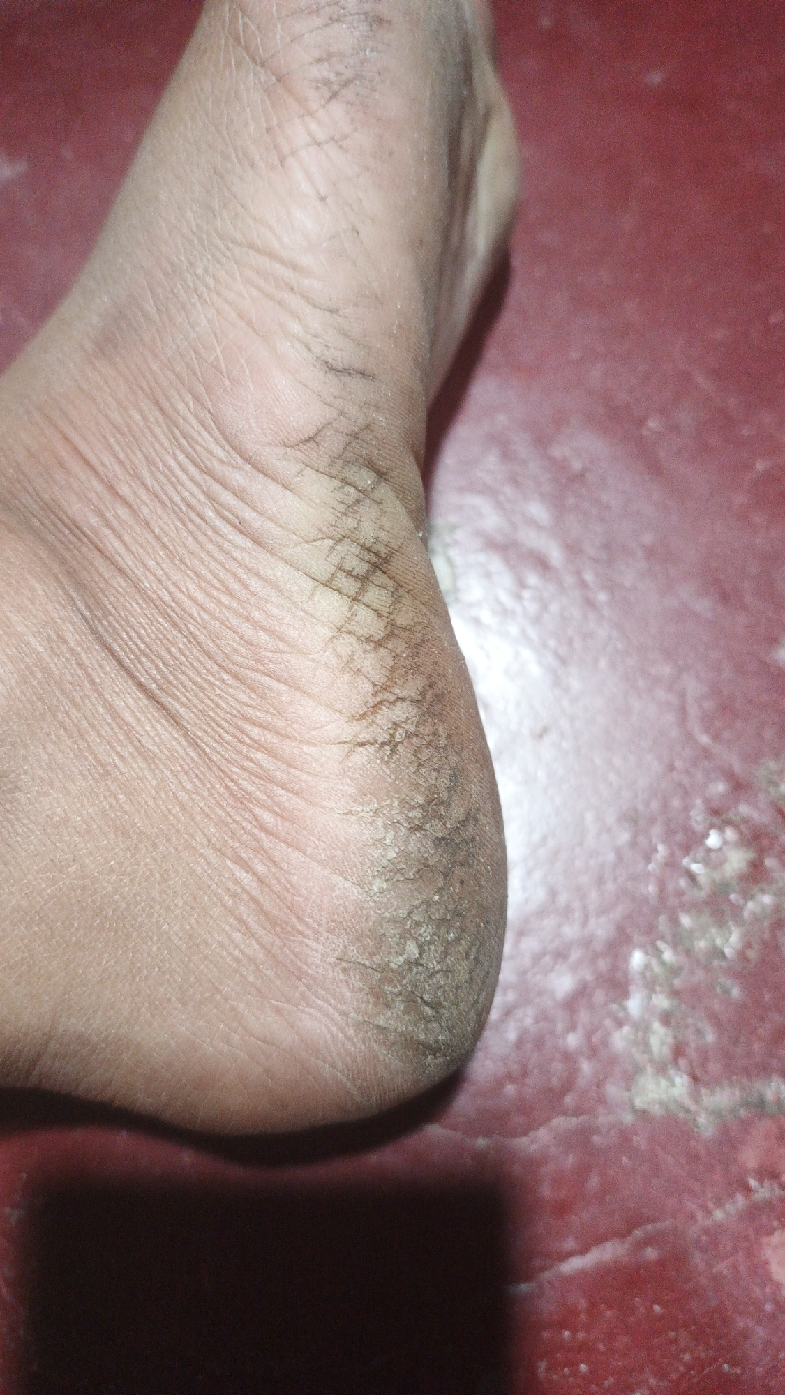 The image shows a close-up view of a cracked and dry heel of a person's foot. The skin is visibly rough, with deep fissures and a layer of dead skin buildup. There are also dark smudges, possibly dirt or a topical application, embedded in the cracks. The background is a textured, reddish-maroon surface, which appears to be a floor or ground. The lighting casts a shadow on the lower portion of the image, indicating a light source from above. The image does not contain any identifiable landmarks or elements that would place it specifically in Gunungreja, Indonesia.