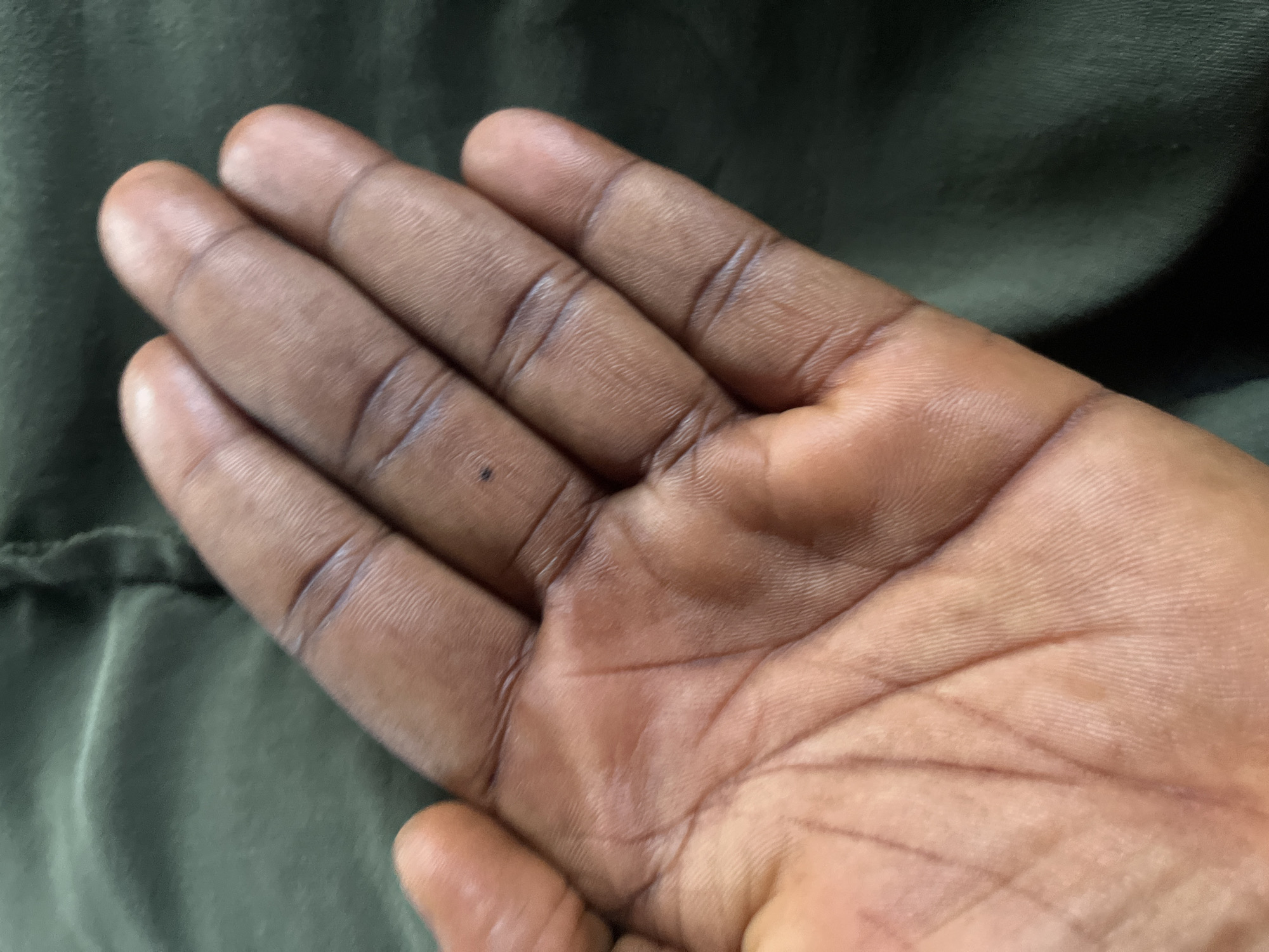 The image shows a close-up view of a person's hand, specifically the palm and fingers, against a dark green, textured background. The hand is dark-skinned and appears to be resting on fabric. The palm shows distinct lines and creases, characteristic of human skin. A small, dark dot is visible on the middle finger. The lighting suggests an indoor setting or an overcast day. The image does not contain any information that would allow for its location to be determined as Jalingo, Nigeria, or any other specific geographic location.
