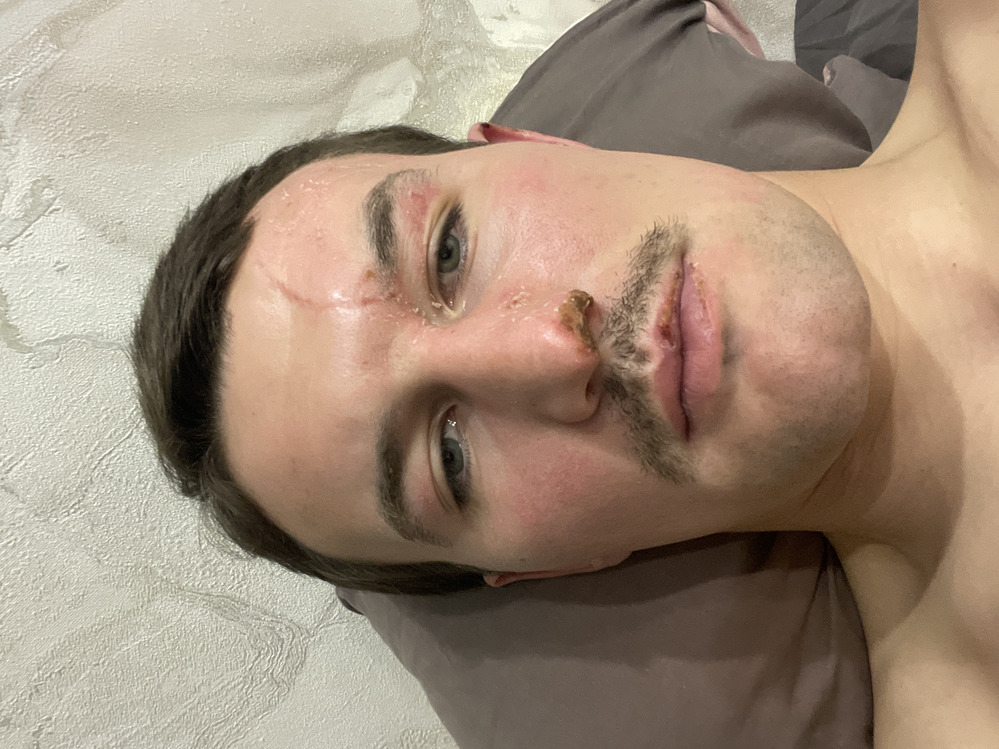 A close-up shot depicts a man lying on a pillow. He has multiple injuries to his face, including abrasions and scabbing on his forehead, nose, and around his mouth. The exact location in Sochi, Russia, cannot be determined from this image.