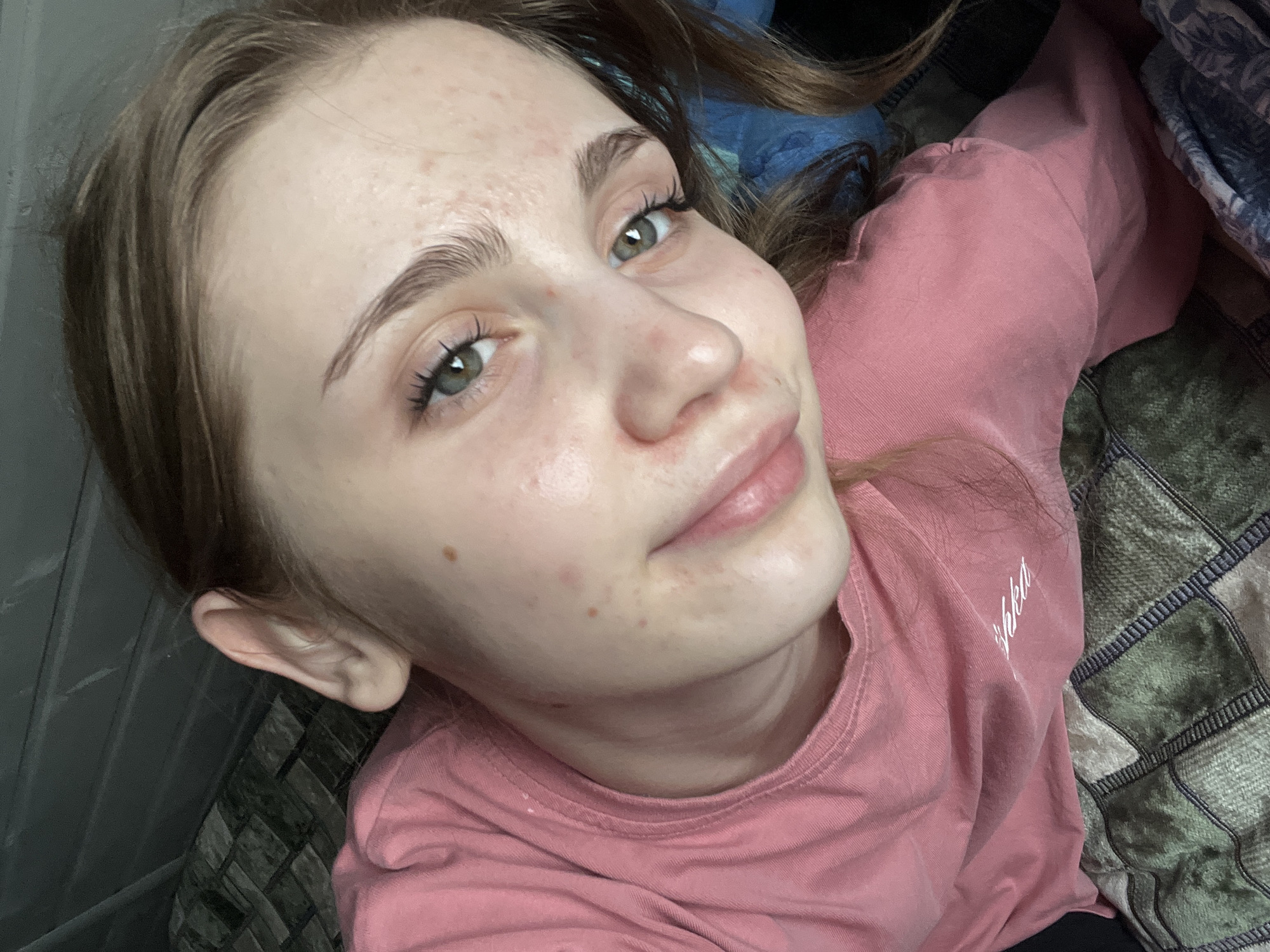 A young woman with fair skin and green eyes is lying down and looking up at the camera. Her face has some blemishes and redness. She is wearing a pink long-sleeved shirt. The background is a dimly lit room with a patterned blanket visible beneath her. There are no identifiable landmarks or contextual clues to suggest a specific location within Ashkadar, Russia.