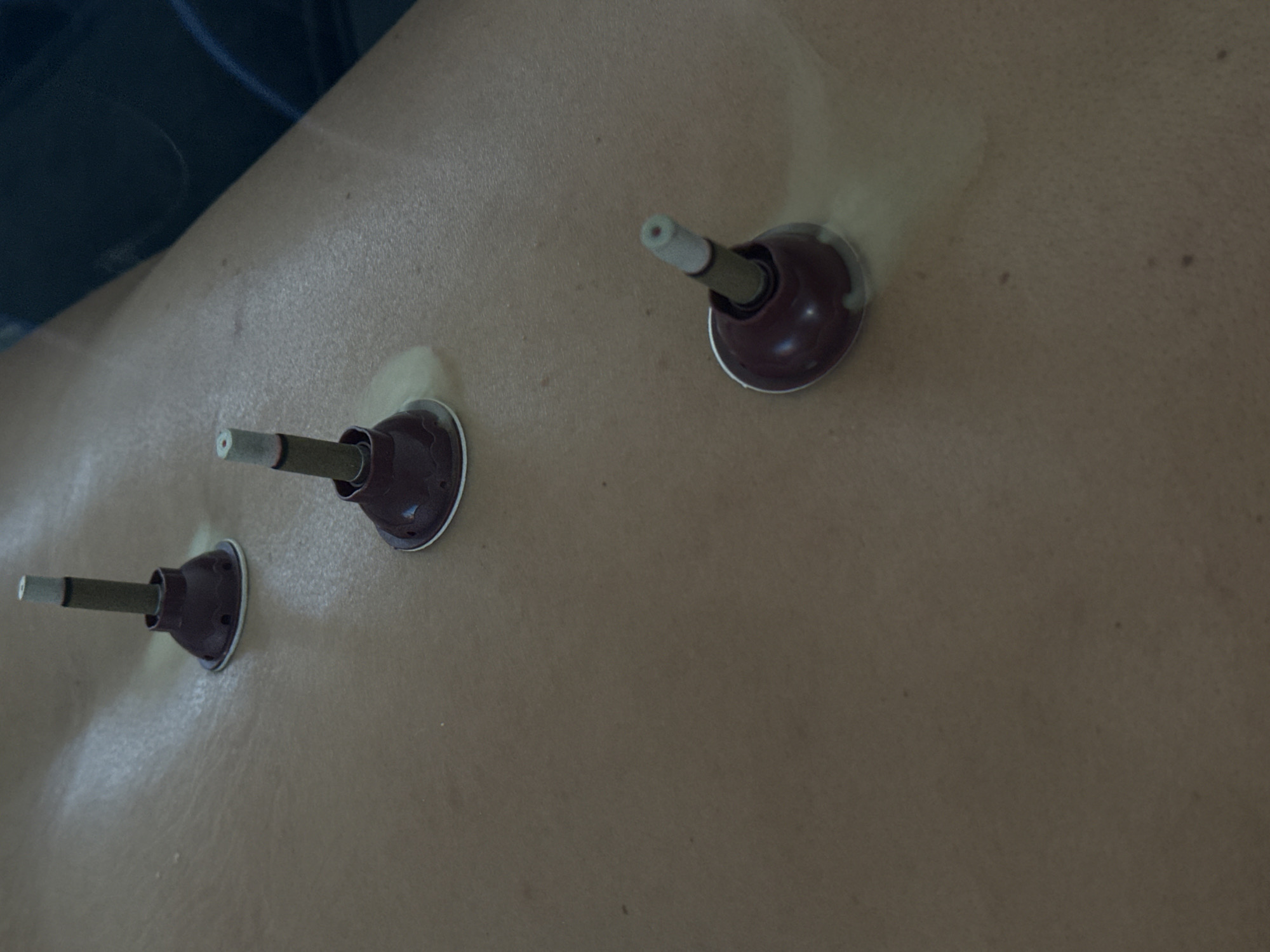 The image shows three cupping therapy cups with moxa sticks attached to a person's back. The cups are arranged in a row, with the moxa sticks appearing to be lit or recently lit, emitting smoke. The person's skin is visible, and the area around the cups appears slightly red. The environment is indistinct, suggesting an indoor setting likely in a medical clinic or a therapy room. There is no indication that the photo was taken in Kharnavy, Russia.