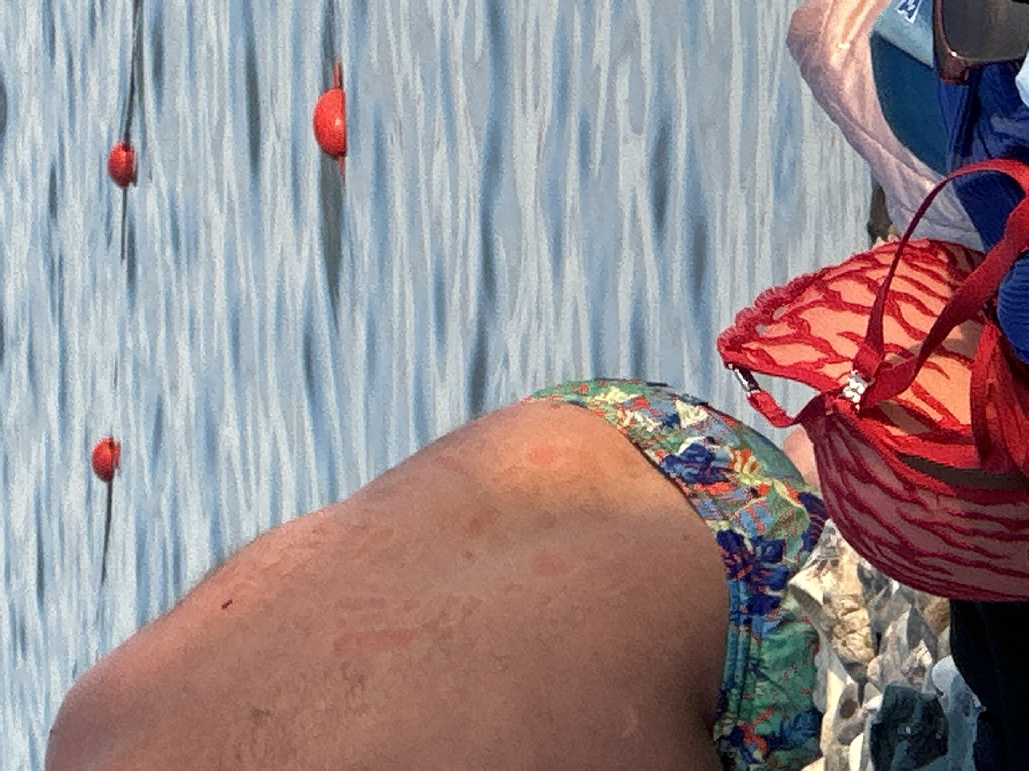 The image captures a close-up view of a person's leg and torso, wearing floral patterned shorts and a red bikini top. The setting appears to be outdoors, possibly near water, given the background which shows a blue, textured surface resembling water with vertical lines. In the background, two red buoys are visible, one closer to the foreground and another further away. To the right, another person is partially visible, wearing blue clothing and a cap. The person's skin on the leg shows some reddish marks, possibly from sun exposure or an insect bite. The image is brightly lit, suggesting it was taken during the daytime. The overall mood is relaxed, implying a casual outing. The location context of Sochi, Russia, might suggest a beach or a poolside environment. No text is visible in the image.