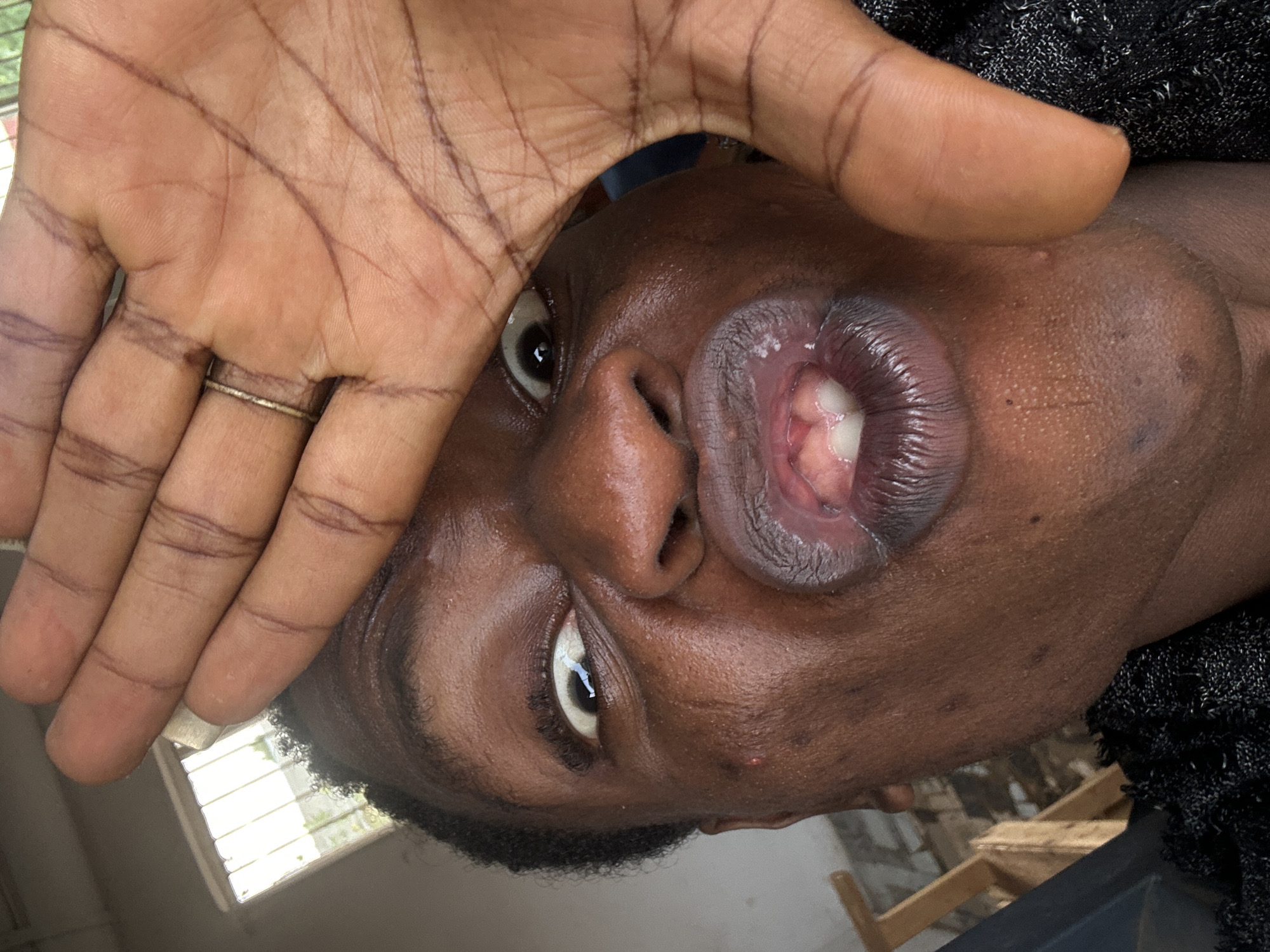 A close-up, upward-angle view depicts a dark-skinned individual with swollen lips, possibly indicating a medical condition or injury. One hand, adorned with a gold ring, is raised near the individual's face. The background shows a partially visible interior setting. The location is unknown.