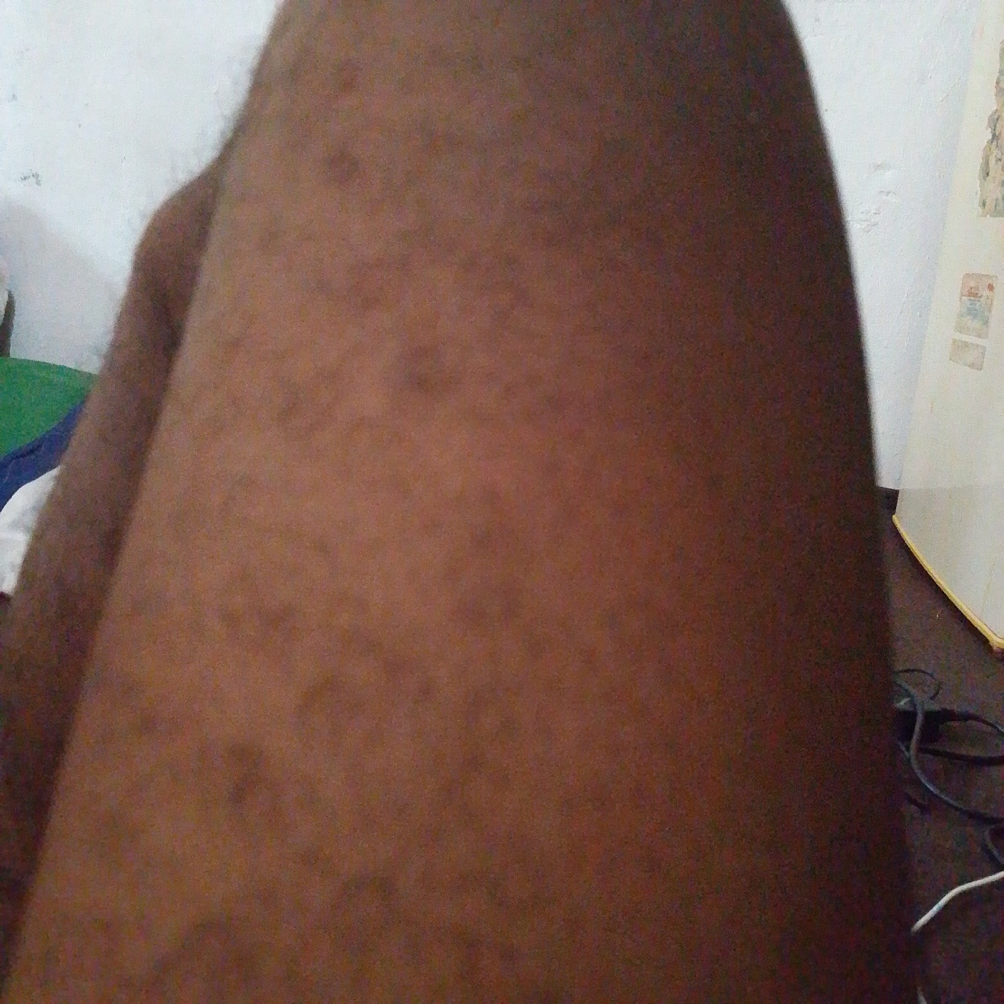 The image shows a close-up view of a person's leg, with skin exhibiting a medium brown tone and some scattered dark spots, potentially representing hyperpigmentation or freckles. The lighting suggests an indoor setting, possibly illuminated by natural light or a soft artificial source, casting a shadow on the left side of the leg. The background is out of focus but hints at a wall on the right, possibly painted white with some faint textures or markings, and a sliver of what appears to be a white appliance or furniture, along with some cables on the floor. The presence of these cables, along with the wall and what might be furniture, suggests a domestic environment. The image is too close and lacks sufficient context to determine the specific location within Jalingo, Nigeria, or any specific activities occurring.