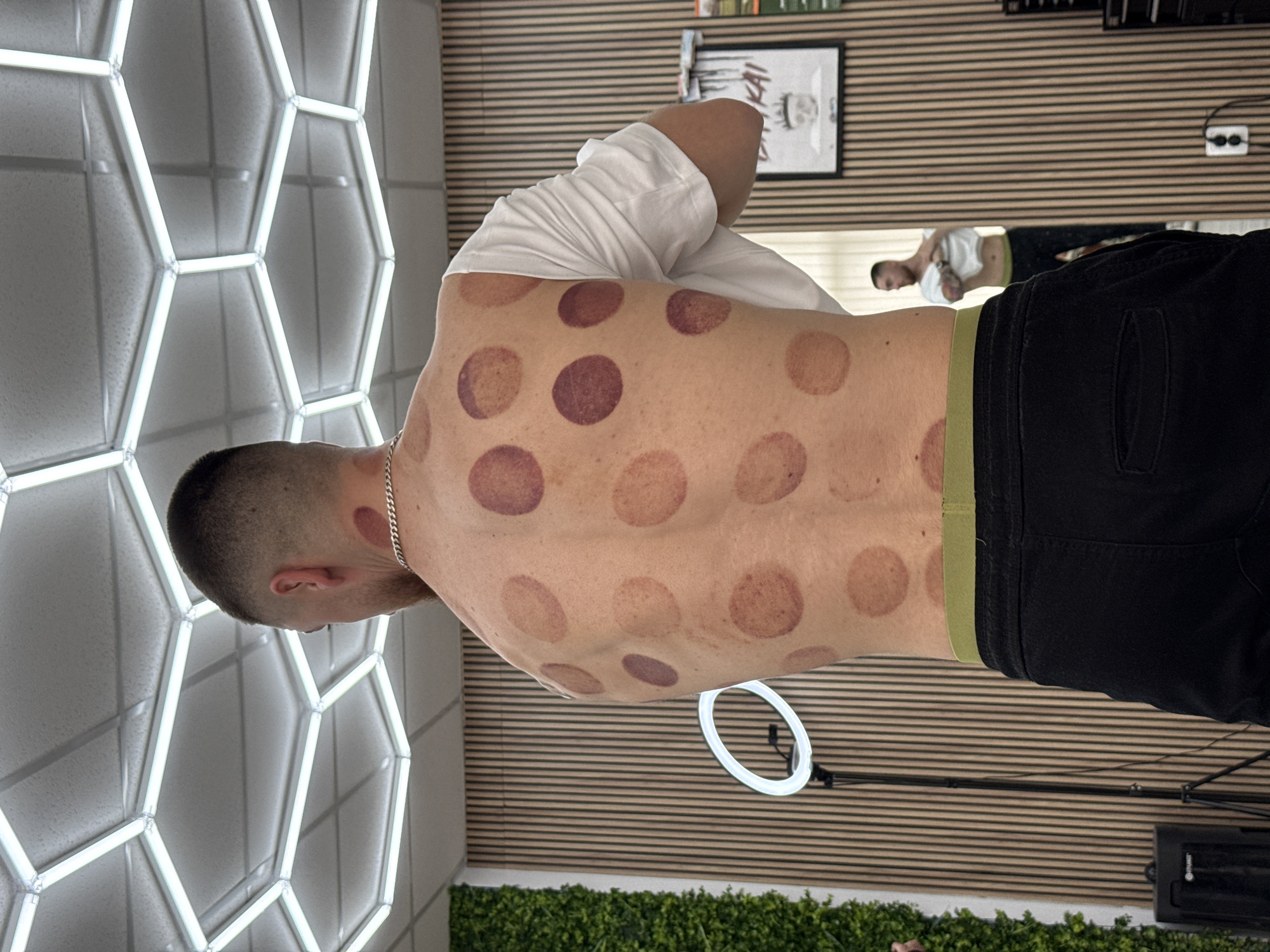 The image shows a man from the back after receiving cupping treatment. He is wearing a white shirt and black pants with a light green band around the waist. His back has multiple circular red marks from the cupping therapy. He has short dark hair and is wearing a silver chain. In the background, there is a wall with a hexagonal light fixture on the left and a horizontally lined wall on the right, with a framed picture hanging on it. A circular light is visible near the man's waist. There is a mirror reflecting another individual. Below the lined wall, there is green foliage. The location is likely indoors but cannot be definitively confirmed as Sofia, Bulgaria without additional context.