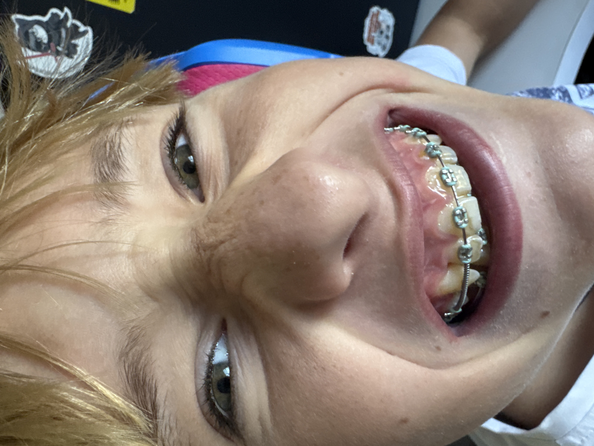 The image is a close-up, selfie-style shot of a young person's face. The person has fair skin, freckles, and blond hair. They are making a distorted, scrunched-up facial expression, with their eyes narrowed and their mouth open to reveal teeth with metal braces. The background is dark and out of focus, with some colorful elements that appear to be part of headphones or a similar accessory. There are also stickers visible on the background. The image's location in Zaporizhzhia, Ukraine, is not determinable from the visual information provided.