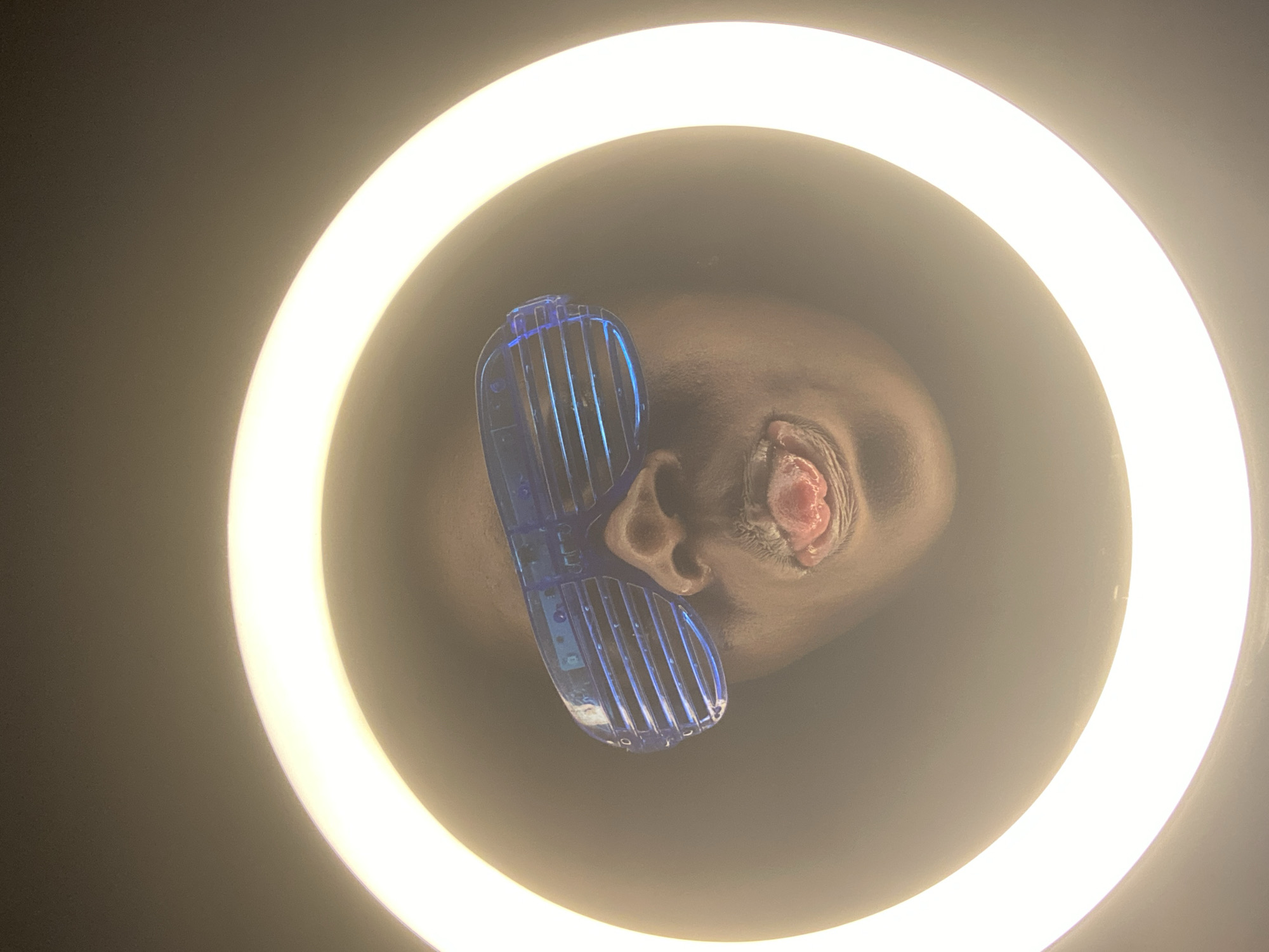 A close-up photograph depicts a person's face, specifically the area around the left ear and eye, encircled by a bright ring light. The person has dark skin. The left eye appears swollen and inflamed, with reddish tissue visible. The person is wearing light blue, slatted sunglasses that cover part of the left eye and cheek. The background surrounding the ring light is dark. No information about the location in Maigizo, Nigeria, can be extracted from the image.
