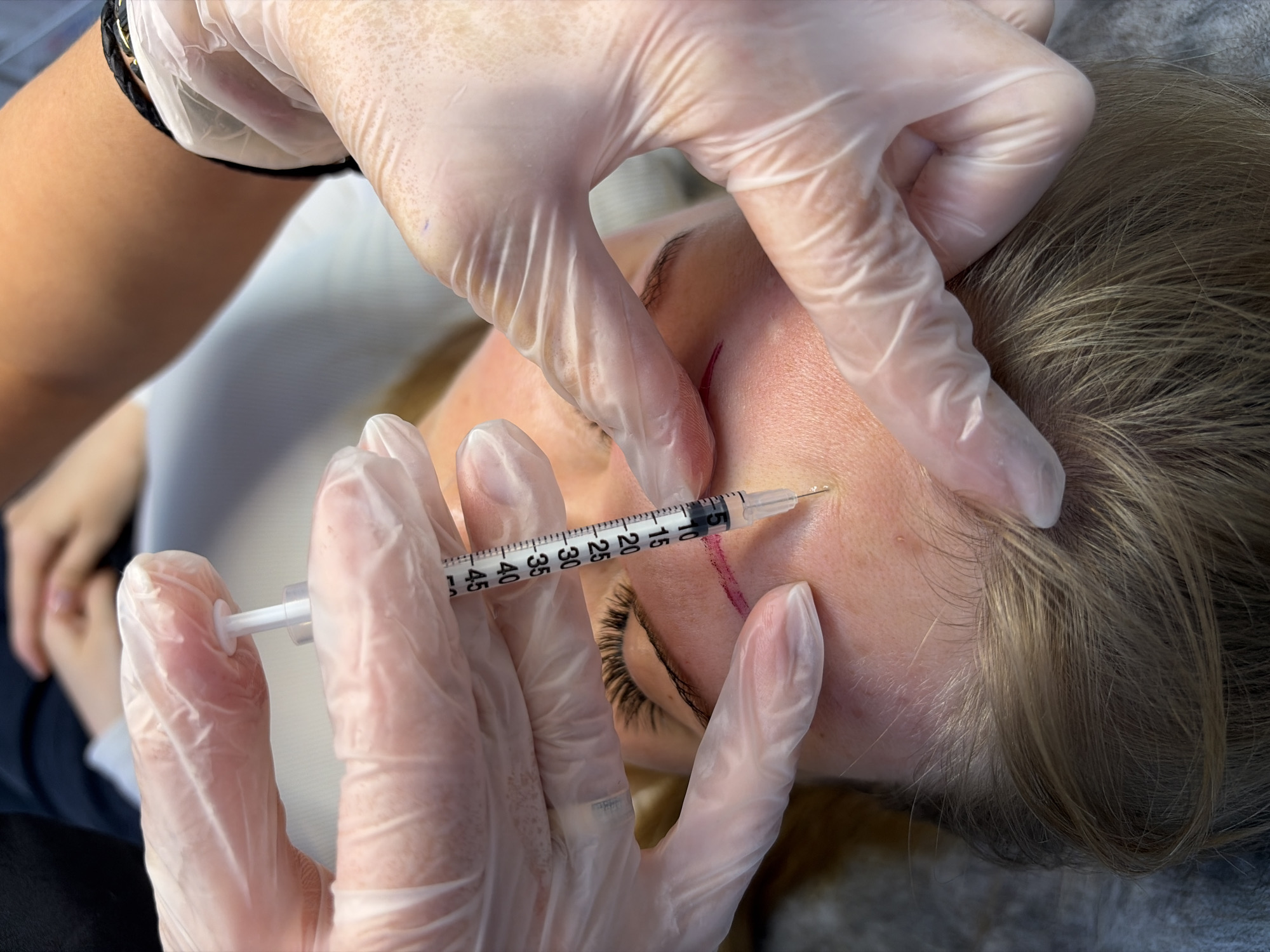A close-up, overhead shot shows a person receiving cosmetic filler injections to their forehead. The subject, with blond hair and prominent eyelashes, is lying down. A medical professional, wearing sterile gloves, holds a syringe and injects a clear liquid into the subject's skin, following a red marking on the forehead. The environment appears to be a clean, clinical setting, possibly a medical spa or clinic. The image does not contain any information to suggest the location in the city of Chaikovsky, Russia.