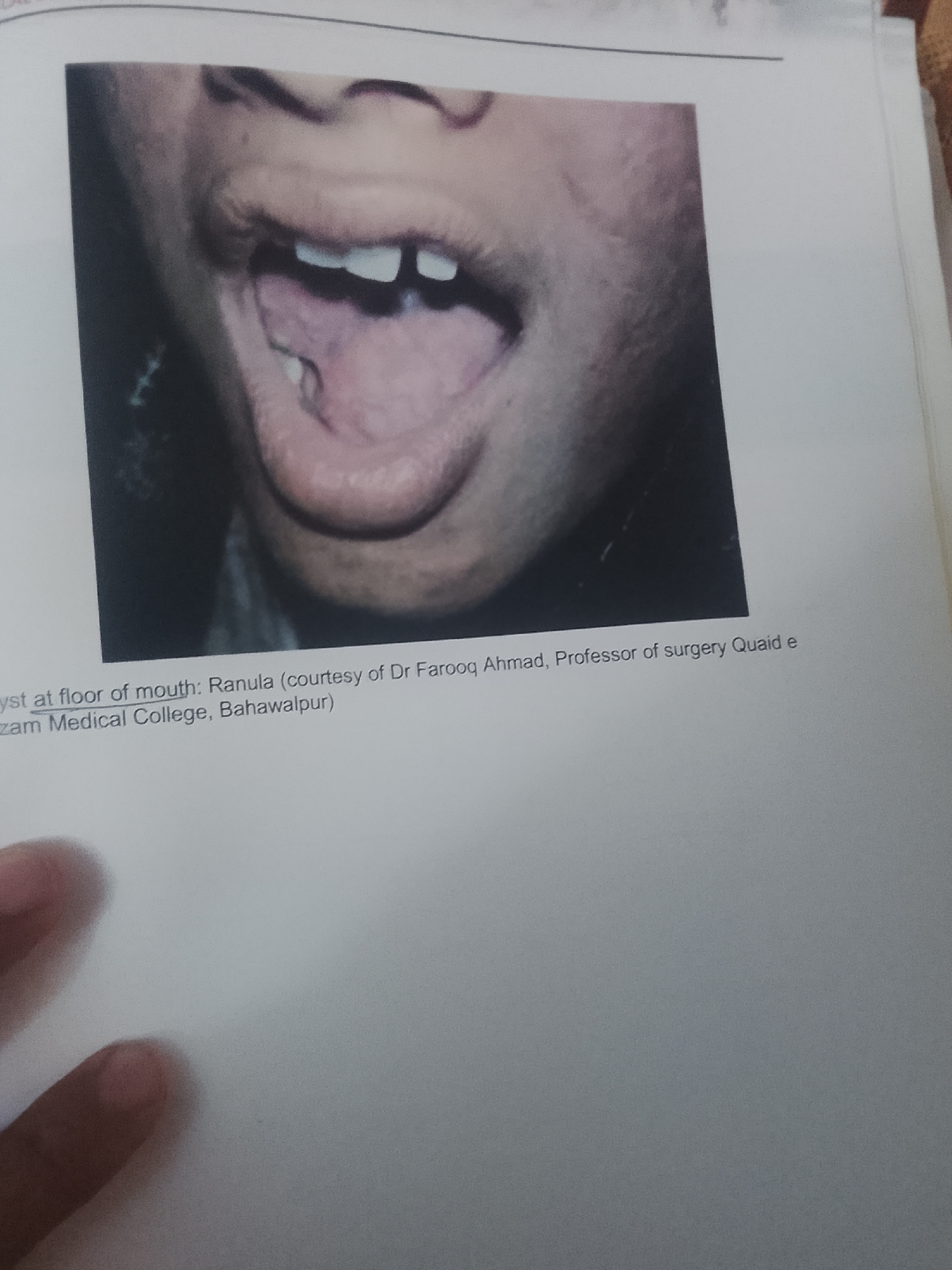 The image shows a close-up of a person's open mouth, revealing the tongue and some teeth. A light-colored cyst is visible on the floor of the mouth, attached to the underside of the tongue. Text below the image reads "yst at floor of mouth: Ranula (courtesy of Dr Farooq Ahmad, Professor of surgery Quaid e zam Medical College, Bahawalpur)". The image is cropped to focus on the mouth and the accompanying text. The location is identified as Bahawalpur.