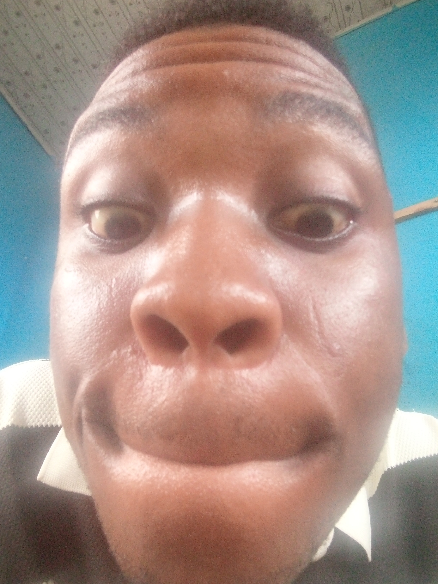 A close-up photograph shows a man's face. His skin is dark and appears oily. His eyes are open and appear slightly yellow in color. He is wearing a black and white shirt. The background is a blue wall with a light-colored ceiling. The location is Unknown, Unknown.
