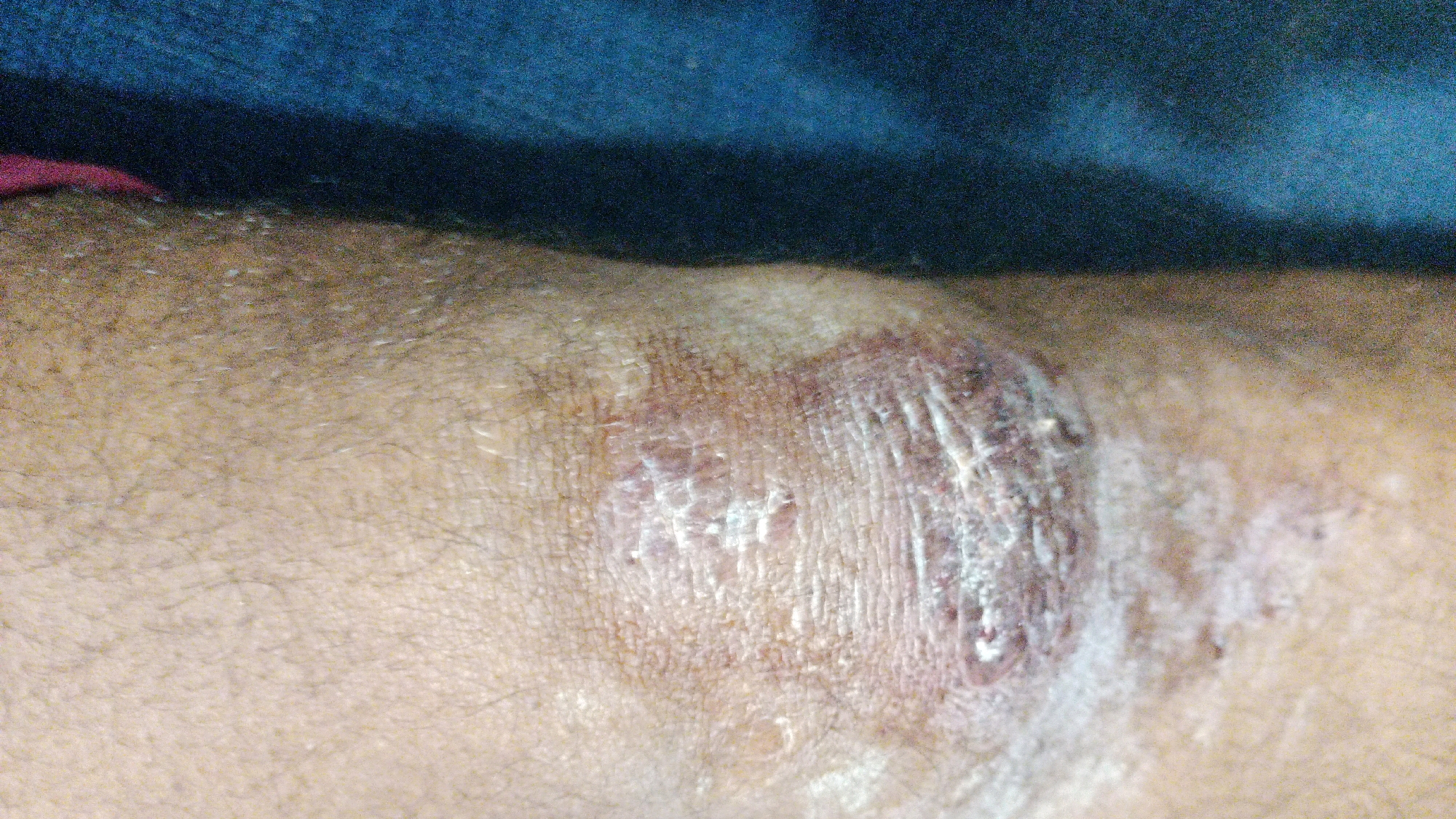 The image shows a close-up view of a person's knee with a visible skin lesion. The lesion appears to be a raised, irregular patch with some redness and scaling. There are also some white, flaky patches on the surface, possibly indicating a topical treatment or dry skin. The surrounding skin is tan and shows some hair growth. The background is blurred, but suggests a dark fabric, possibly clothing or a blanket. The image is taken from a slightly elevated angle, focusing on the knee. No other individuals or objects are clearly visible. There is no information to indicate the location in the city of Deoghar, India.