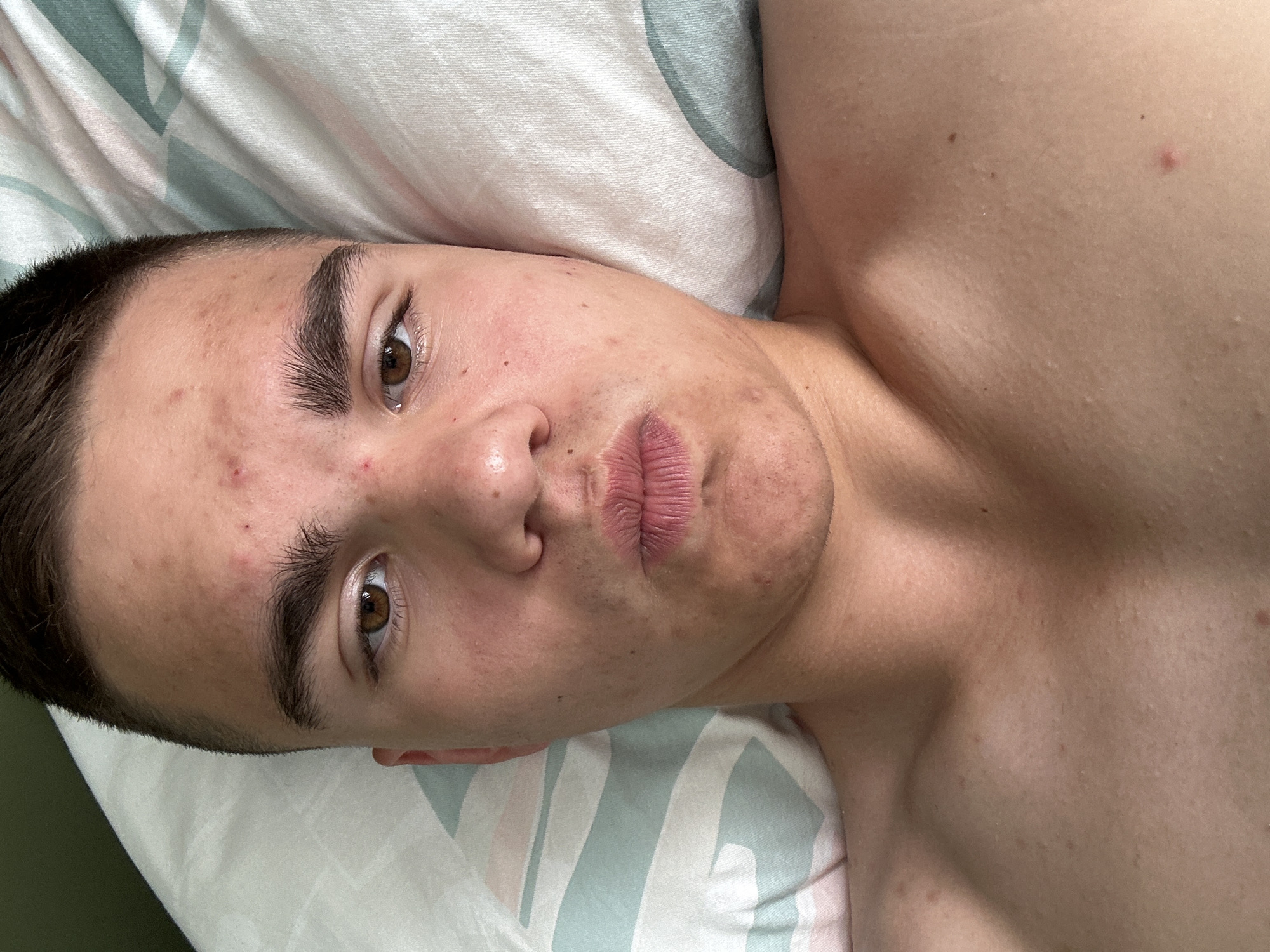 An overhead, close-up shot shows a young person lying on their back on a pillow and sheets, looking directly at the camera. The person has short, dark hair, brown eyes, and is bare-chested. Their face is close to the camera, with their lips pursed. There are several red blemishes on their forehead and cheek. The pillow has a repeating pattern of diagonal lines in white, light green, and pastel pink. The sheets are white with a similar pastel pattern. The lighting is natural, and the focus is sharp on the person's face.