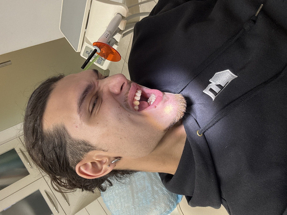 The image displays a young adult male in what appears to be a dental examination room. He is positioned in a dental chair, indicated by a light blue disposable headrest cover behind his head. The male has dark hair styled in a bun with shaved sides, a light goatee, and a silver hoop earring in his left ear. He is wearing a black hooded sweatshirt featuring a grey embroidered logo on the left chest. His mouth is wide open, exposing his teeth, and his facial expression suggests discomfort or an exaggerated grimace, with eyes squinted. A bright light illuminates his lower jaw. To the right, a white dental curing light with an orange protective shield and a green tip rests on a beige dental unit equipped with a control panel. White medical cabinetry with silver handles is visible in the background. The specific location within Sofia, Bulgaria, cannot be determined from the visual information provided.