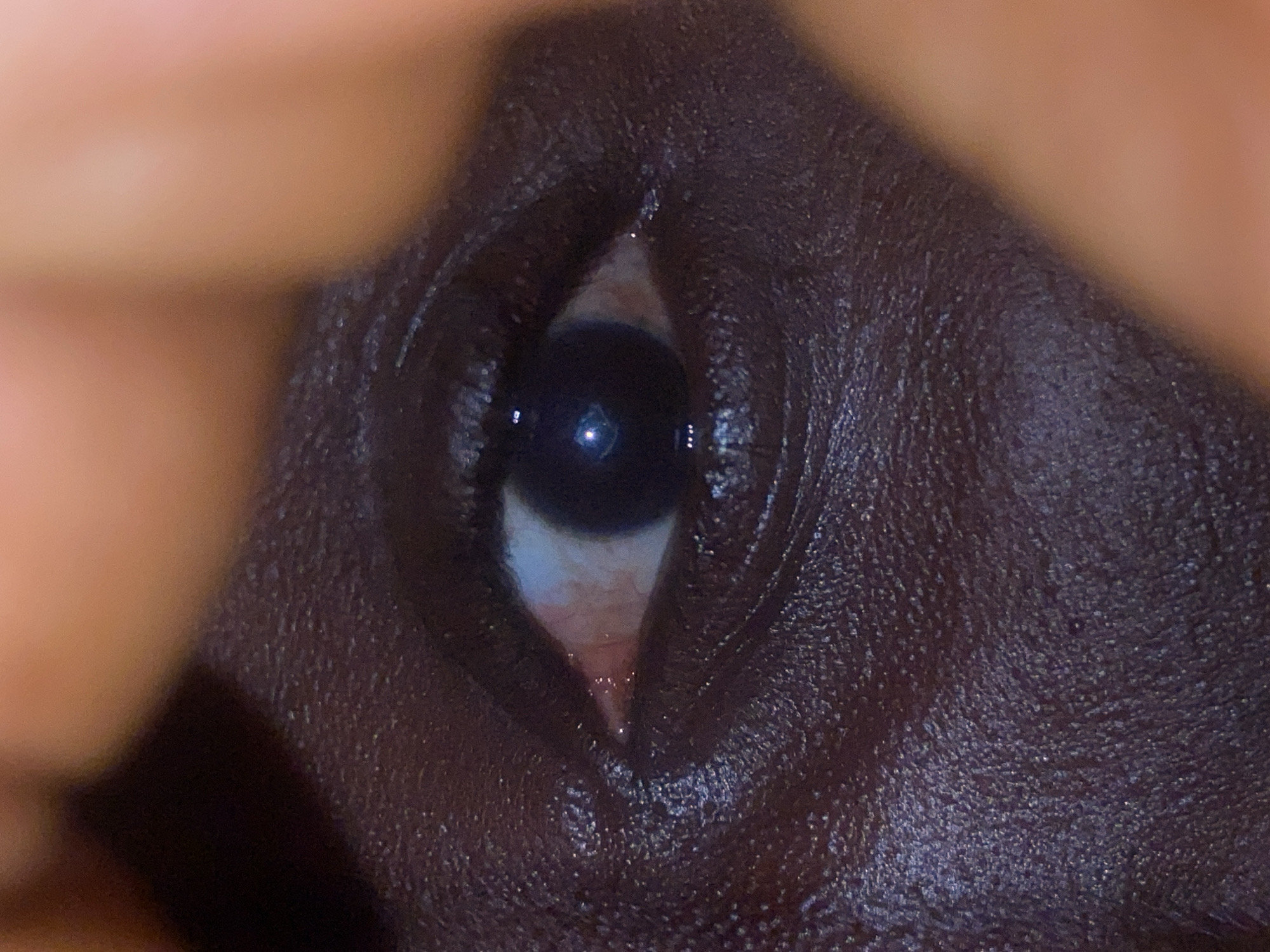 A close-up photograph depicts a partially open human eye. The surrounding skin is dark brown, exhibiting a textured surface. The visible portion of the iris is dark, almost black, reflecting light. A small area of the sclera, appearing white, is visible on either side of the iris. The eye is partially obscured by fingers or skin. The location is not discernible from the image.