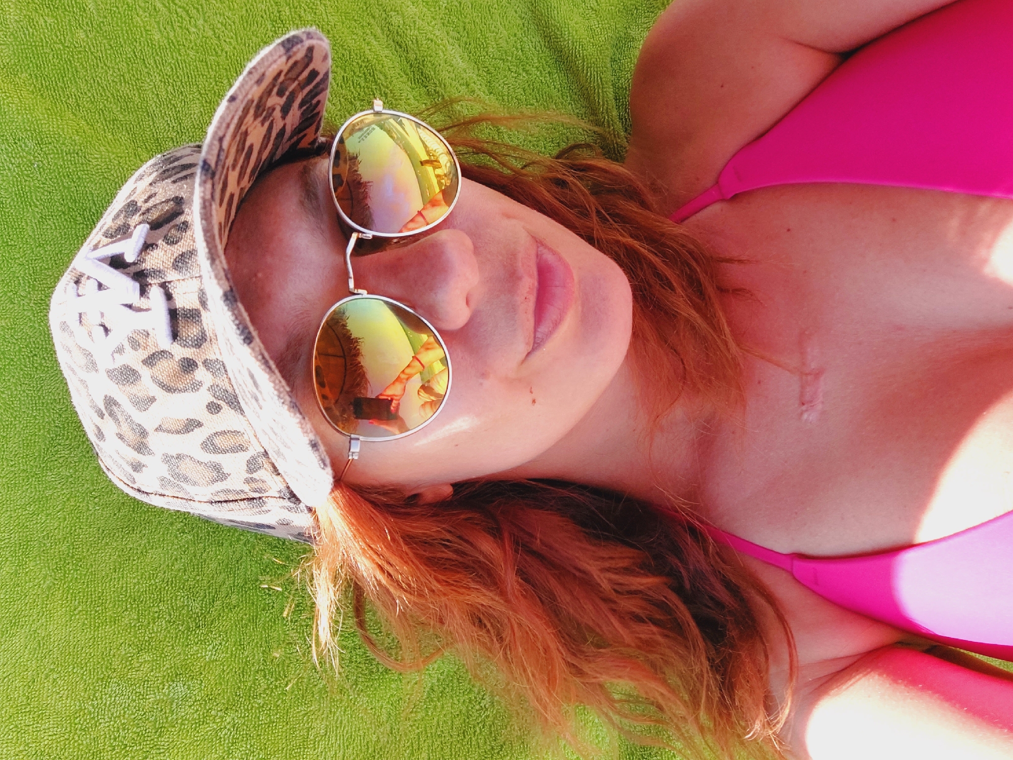 In this close-up, overhead shot, a woman with bright red hair and wearing a leopard-print baseball cap and pink bikini top is lying on a green towel. The woman is wearing round, reflective sunglasses that show a reflection of a beach scene with umbrellas and the ocean. A scar is visible on her chest. The image appears to have been taken outdoors on a sunny day, likely at a beach resort in Sozopol, Bulgaria, given the context of the prompt.