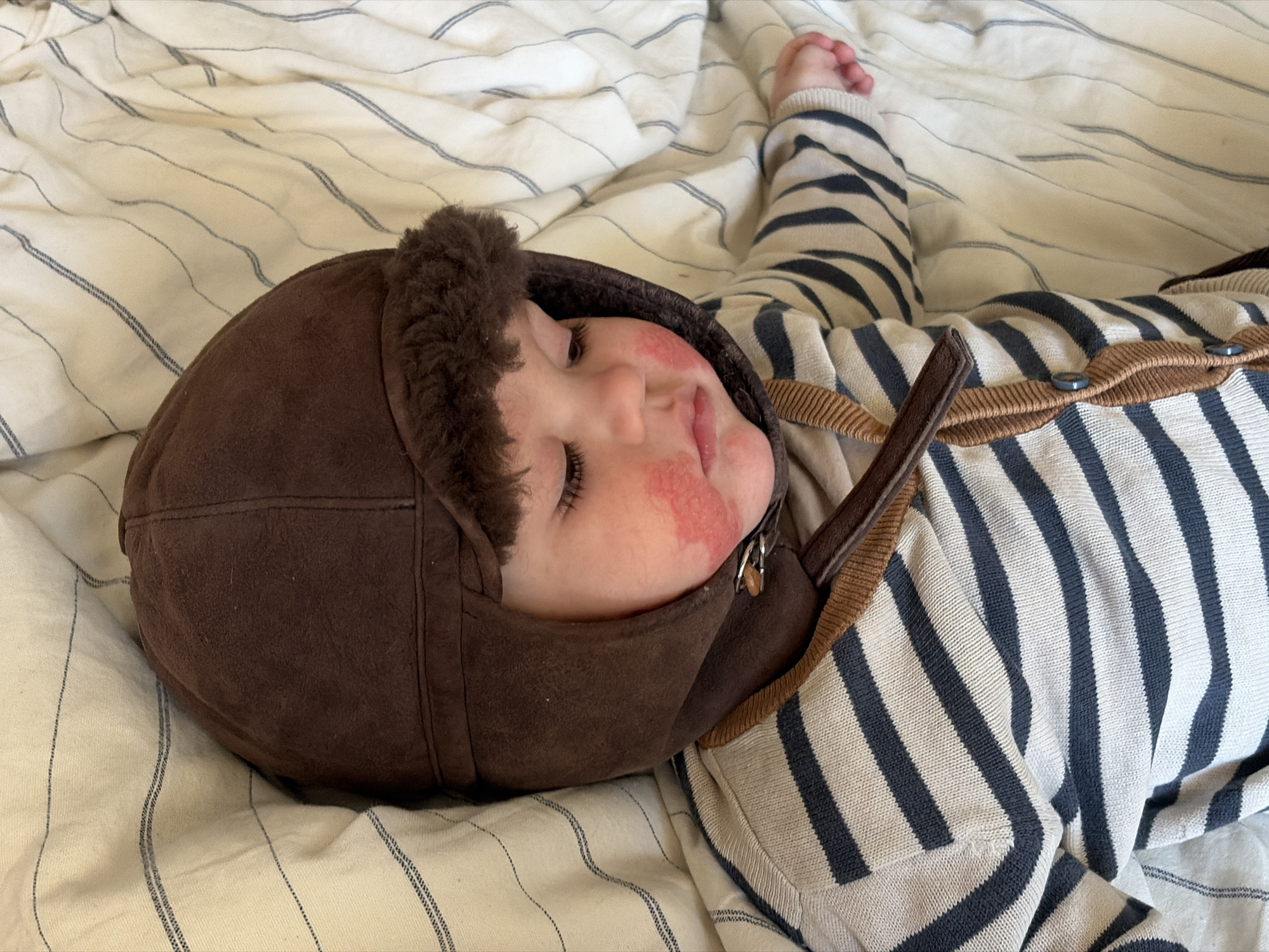 A baby is lying on a white and blue striped bedsheet. The baby is wearing a brown aviator hat with faux fur trim and a blue and white striped cardigan with brown accents. The baby has a rash on its cheeks. The location is not discernible from the image. There are no discernible actions or interactions.