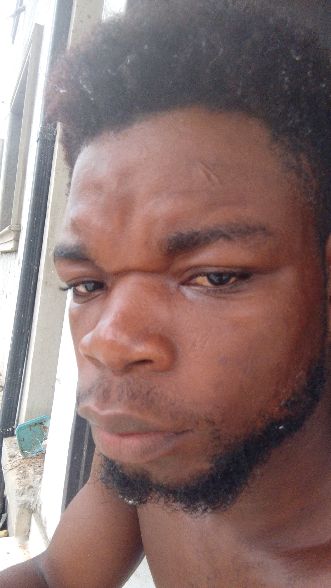 This is a close-up portrait of an adult man, likely of Black African descent, taken outdoors in Enugwu-Ukwu, Nigeria. The man dominates the frame, with his head and upper chest visible. He has dark skin, dark, tightly curled hair, and a short, dark beard and mustache framing his chin and jawline.
His facial features include a prominent nose and full lips. A distinct, slightly diagonal scar is visible on his forehead, and another scar is present on the bridge of his nose. His left eye (viewer's right) appears somewhat bloodshot or yellowish in the sclera. He looks towards the viewer with a neutral to serious expression.
The background is out of focus, suggesting an outdoor setting during daylight. Visible elements in the background include vertical white or light-colored structures, possibly part of a building or a window, and a concrete surface. A small, blurry, turquoise-colored object is partially visible on the concrete in the lower left. The lighting indicates natural sunlight, with some glare on the man's skin, particularly on his forehead and nose. There is no visible text in the image.