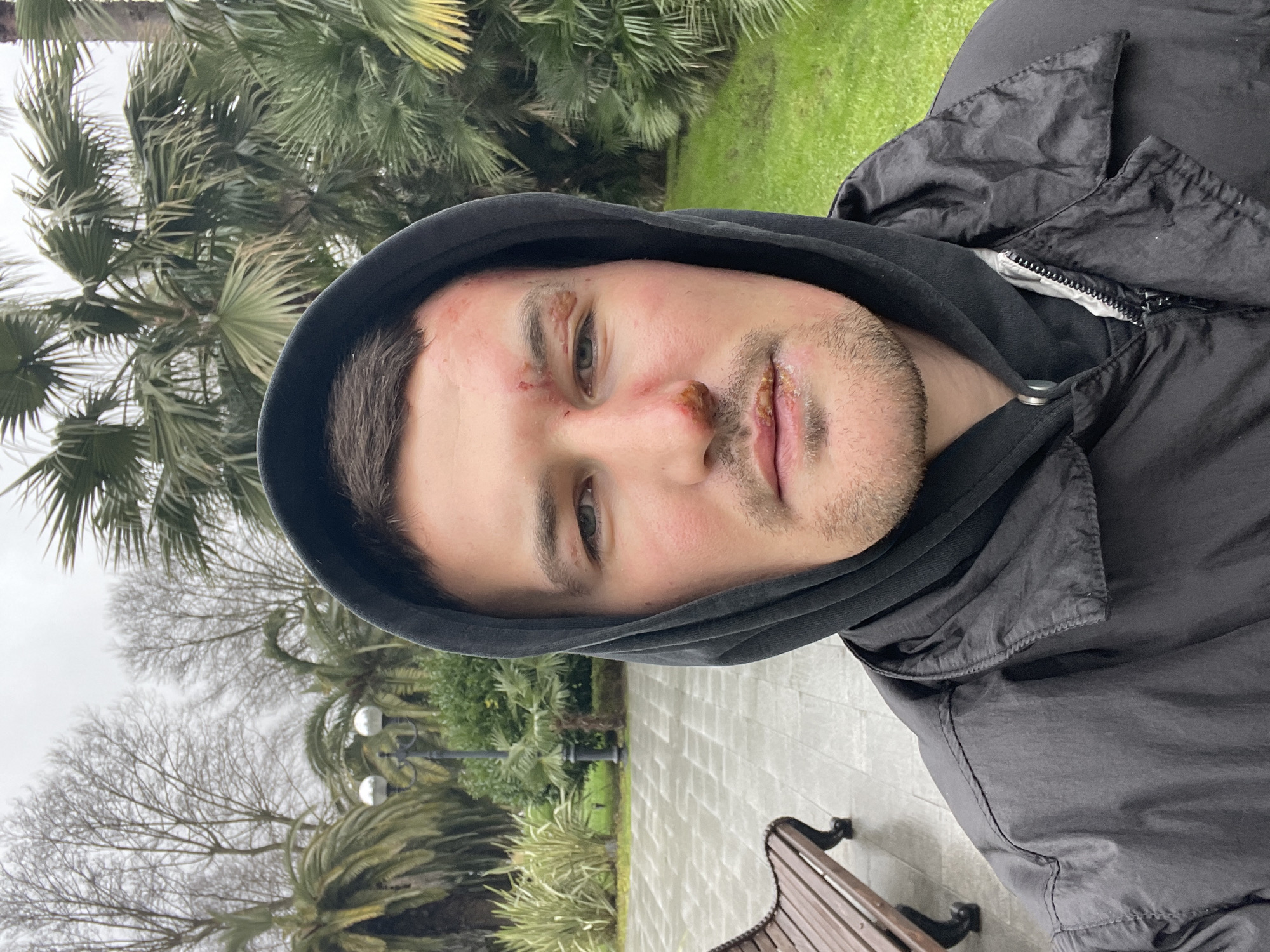 A male individual is depicted in a frontal, head-and-shoulders view in an outdoor, park-like setting under overcast conditions. He wears a dark hooded sweatshirt with the hood pulled over his head and a dark, partially unzipped jacket over it.
The subject exhibits facial injuries:
- A superficial abrasion with dried blood is present on the forehead, superior and slightly medial to the left eyebrow.
- The area around the left eye, including the eyelid and periorbital region, shows swelling and erythema, consistent with a contusion.
- The nasal bridge and tip present abrasions and dried blood, predominantly on the left side.
- The upper lip appears swollen.
- The lower lip exhibits significant abrasions, possibly with minor lacerations, and dried serosanguinous fluid with yellowish crusting, particularly on the left side.
- Facial hair growth indicates light stubble.
The background consists of a grey-tiled or paved walkway visible to the left, where a wooden park bench with dark metal legs is partially observed. Green grass and various plant species, including numerous palm trees and bushes, are present throughout the mid-ground and background. In the deeper background, several bare deciduous trees are visible, indicating a seasonal change. Two ornamental streetlights with spherical fixtures are positioned behind the subject. The vegetation mix of palm trees and deciduous trees, combined with the general park infrastructure and overcast weather, is consistent with a humid subtropical climate, such as that found in Sochi, Russia, on the Black Sea coast.