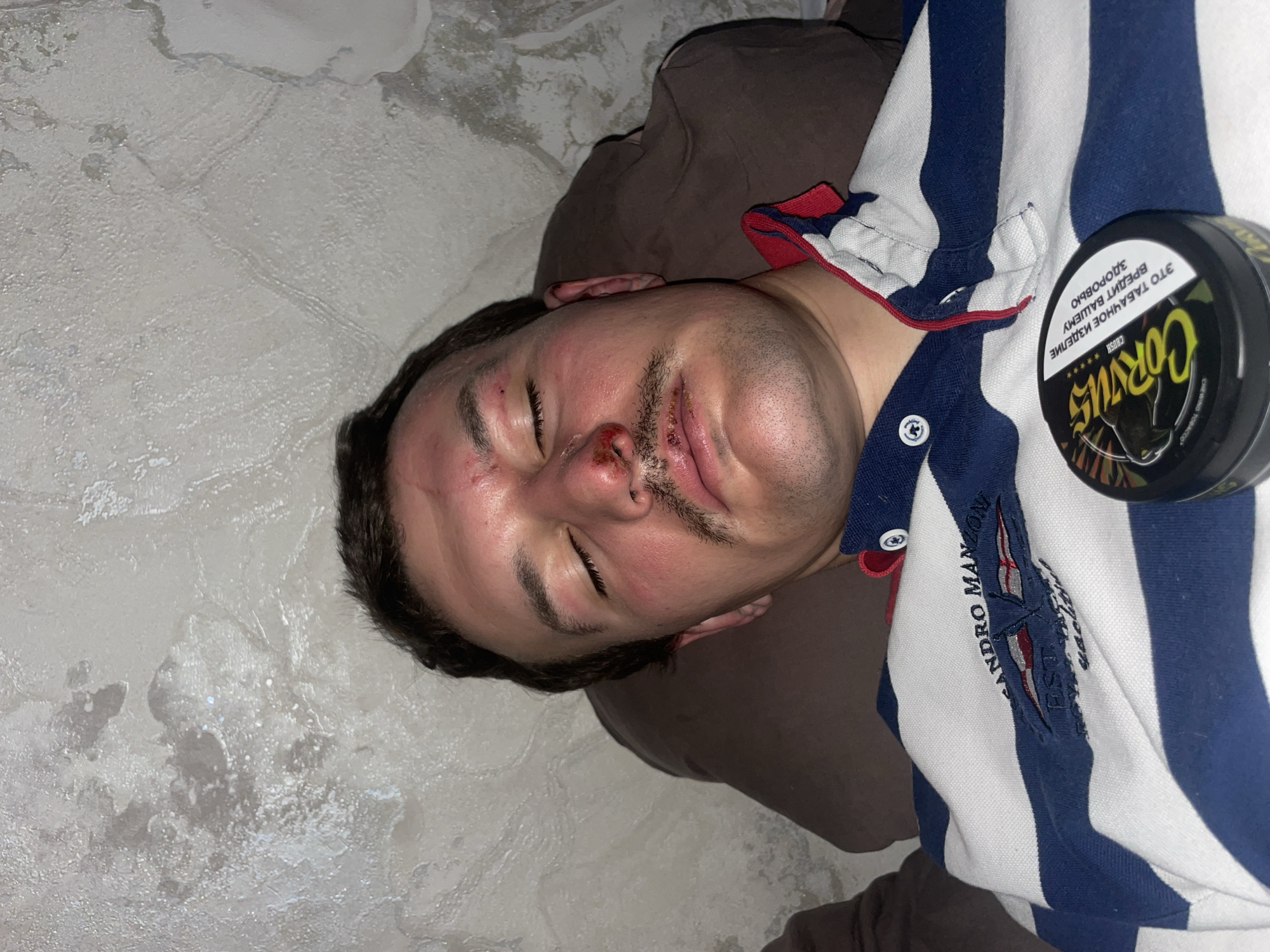 A man with facial injuries lies on a textured, light-colored surface. He has abrasions and blood around his nose and above his eyes. He wears a striped polo shirt. Next to him is a tin of chewing tobacco labeled "CORVUS". The location is unknown and there is no indication of this photo being taken in Sochi, Russia.