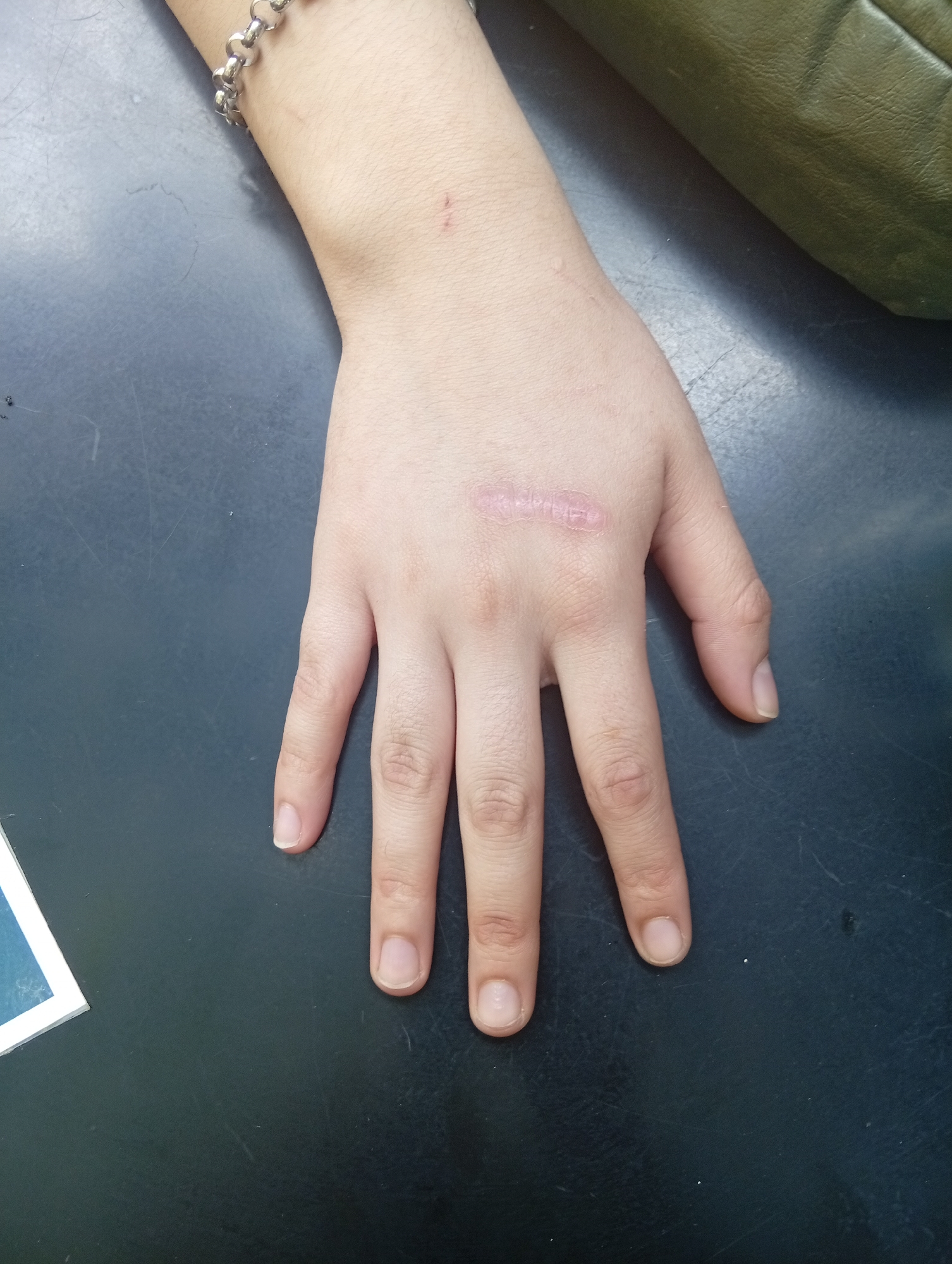 A close-up shot shows a light-skinned human hand with a scar across the back, resting on a dark surface. A silver bracelet is visible on the wrist. A blurred green object is partially visible at the top right. The background is a mottled, dark gray surface. The location is not discernible from the image. There is no indication of this being in Buenos Aires, Argentina.