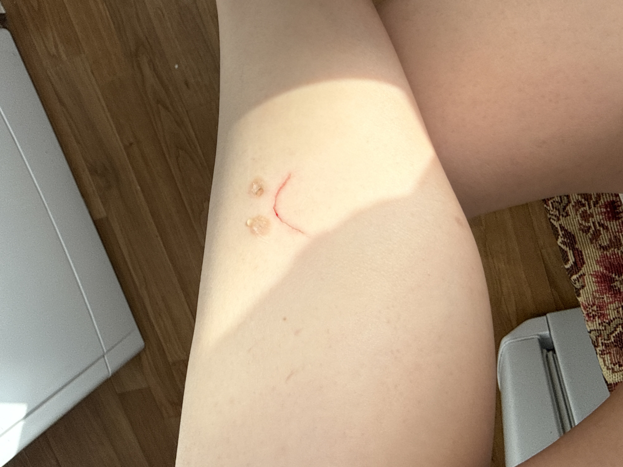The image displays a close-up view of a human right thigh or upper leg, exhibiting fair skin tone. Two raised, translucent lesions, consistent with blisters or insect bites, are present on the anterior surface, approximately 5-7mm in diameter and positioned superiorly. Directly inferior to these, a curved, superficial linear abrasion or laceration, approximately 4-5cm in length, is visible, showing a distinct red color suggesting fresh injury. These three markings together form a representation of a sad face. A distinct shadow from an unseen object or limb falls across the leg from the upper right.
The background reveals elements of an indoor environment. The floor is composed of light brown wooden planks visible in the upper and lower portions of the frame. In the upper left corner, a portion of a white, angular object, possibly furniture or an appliance, is visible. A patterned textile or rug with red, cream, and darker hues is partially visible in the lower left corner of the frame.
The image contains no discernible information to determine its specific location within Saint Petersburg, Russia, or any other geographical area.