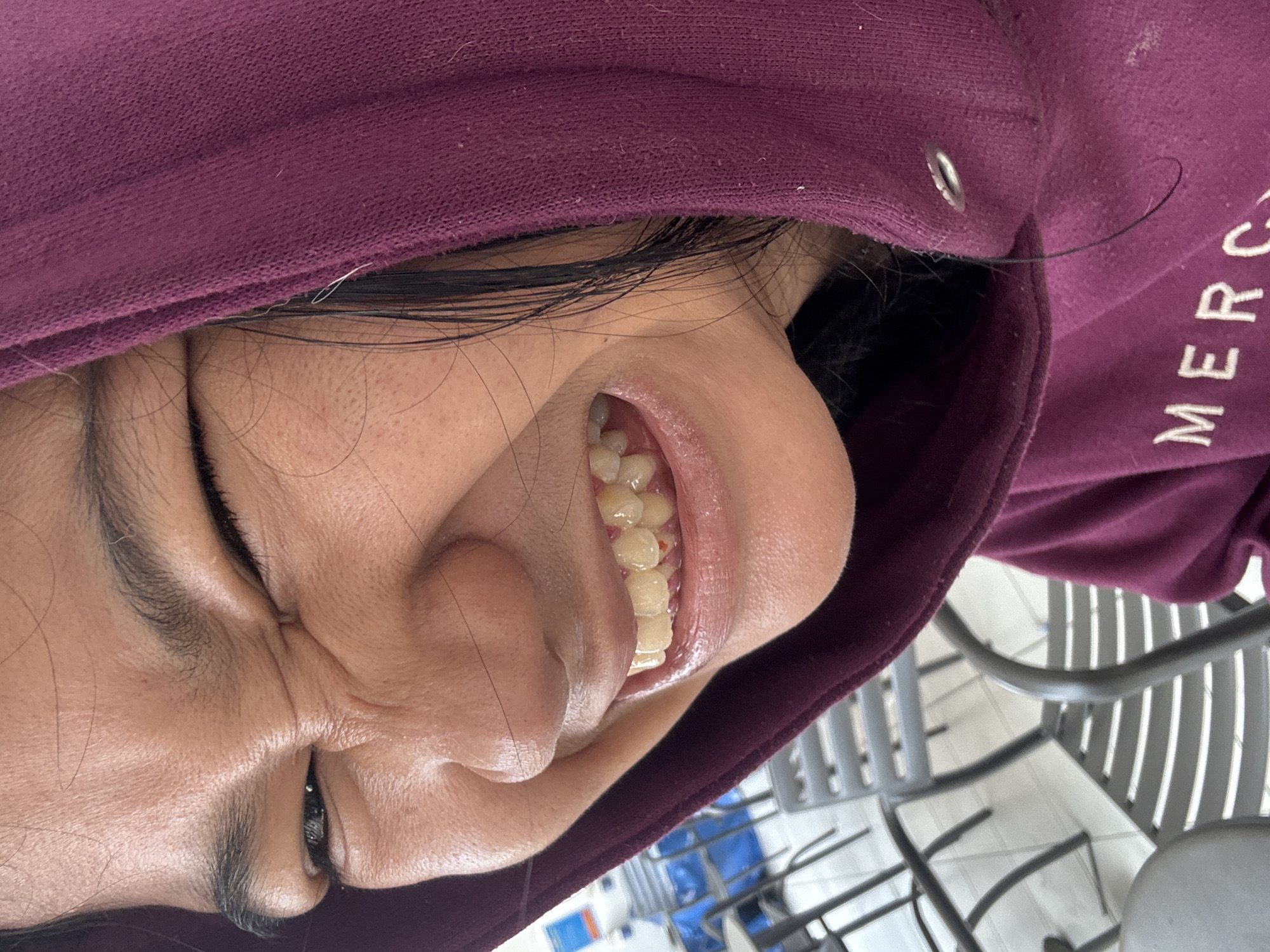 A close-up, eye-level, outdoor shot captures a young person's face contorted in a wide, toothy grimace, their eyes squinted shut. They are wearing a dark purple hooded sweatshirt with the hood pulled up, obscuring part of their face and head. The sweatshirt has a white embroidered logo, with the letters "MERC" partially visible. The background is blurred and out of focus, showing elements of an outdoor seating area with metal chairs and tables. Some plastic containers and shelves are visible in the far background, suggesting a cafe or casual dining establishment. The lighting is bright and natural, indicating it is daytime. The setting appears to be an open-air dining area in a commercial district of North Jakarta, Indonesia, possibly a food court or a cafe with outdoor seating.