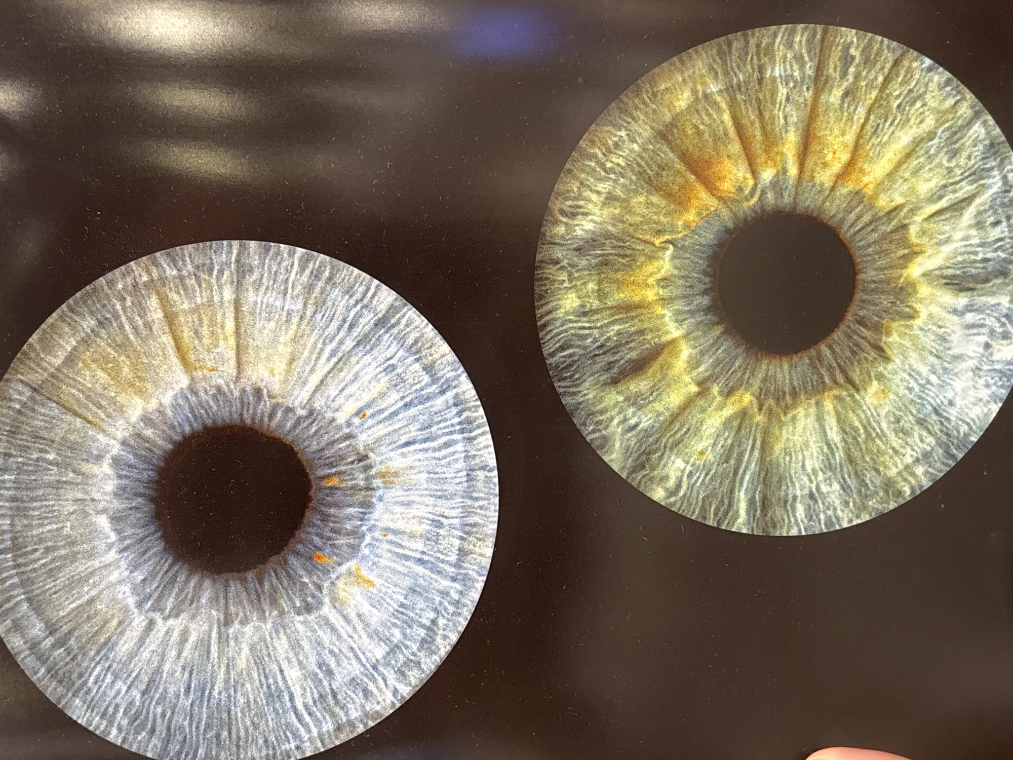 The image presents two magnified, circular representations of human irises against a dark, matte background.
**Subjects:** The primary subjects are two highly detailed human irises. The background is a uniform, dark surface, likely black or dark brown, with minimal texture. A human finger is partially visible in the bottom right corner of the main image.
**Activity or event:** The image appears to be a still display or photographic presentation of the two irises, possibly for educational, artistic, or comparative purposes. There is no dynamic activity depicted.
**Notable details:**
* **Left Iris:** This iris is predominantly blue-gray, characterized by intricate radial lines and patterns extending from its central black pupil. Subtle, scattered specks of light brown or amber are visible within the blue-gray field, particularly closer to the pupil.
* **Right Iris:** This iris displays a distinct color profile, featuring a blend of greenish-yellow and amber tones. The yellow-orange hues are more concentrated and vibrant in the inner ring around the central black pupil. Similar to the left iris, it exhibits fine, fibrous textures radiating outwards.
* **Texture and Detail:** Both irises show remarkable detail, highlighting the unique patterns and striations characteristic of the human iris. The pupils are consistently deep black.
* **Background:** The dark background serves to emphasize the vibrant colors and intricate details of the irises. It appears to be a flat surface, with some subtle variations in light reflection visible in the upper part of the main image.
* **Finger:** The presence of a partially visible finger suggests a human interaction with the displayed images, possibly indicating a physical print or screen being photographed.
* **Lighting:** The lighting is even and bright, illuminating the irises' intricate structures without harsh shadows.
* **Time of Day/Weather/Location/Emotions:** None of these details are discernible from the image.
**Visible text:** There is no visible text in the image.