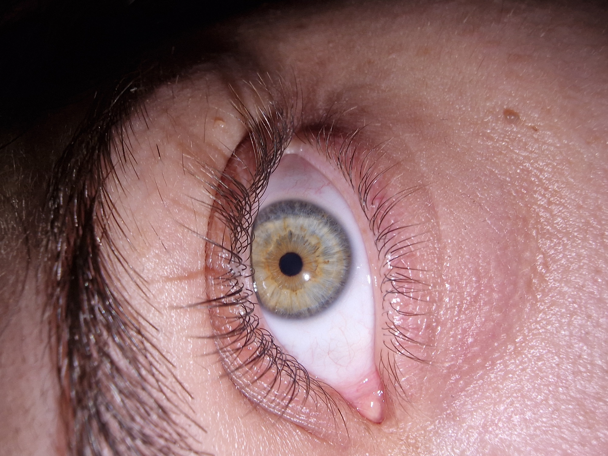 A close-up image depicts a human eye, appearing watery and slightly bloodshot. The iris is a mix of colors, primarily grey and light brown/gold. Eyelashes are visible on the top and bottom eyelids, and a portion of the eyebrow is visible on the left side of the image. The surrounding skin shows texture and slight imperfections, including a small mole or skin tag near the upper right. The background is dark and out of focus. Location: Unknown, Unknown.