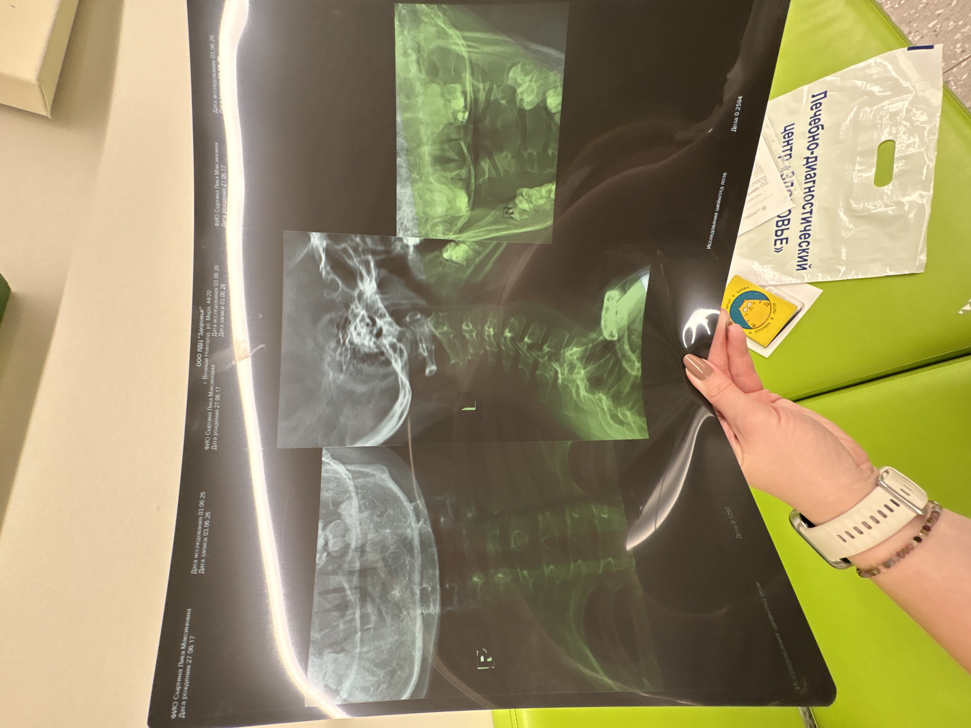A person's hand holds up a large sheet of medical imaging, likely X-ray or CT scans, displaying several views of a skull, cervical spine, and possibly other spinal sections. The imaging features both grayscale and green-tinted visuals of bone structures. The hand has manicured nails with light brown polish, wears a white-strapped digital watch, and a beaded bracelet.
The background consists of bright green upholstered furniture, suggesting an indoor setting such as a medical office or waiting room in Veliky Novgorod, Russia. Beside the imaging, there is a white plastic bag from a "Лечебно-диагностический центр «ЗОВЬЕ»" (Treatment and Diagnostic Center "ZOVYE") and a small, round yellow object with a cartoon face, bearing the text "CHEER UP" and "ПЕРЕМЕН" (changes).
Visible text on the medical imaging identifies the patient as "ФИО Сыртина Лика Максимовна" (Syrtina Lika Maksimovna), with a date of birth "27.06.17". The examination and record dates are listed as "03.06.26". The facility is "ООО ЛДЦ "Здоровье"" (LLC LDC "Health") located at "г. Великий Новгород, ул. Мира, 44/20". Further labels indicate "Исследования шейн/отд позв" (Examination of cervical/spinal section) and radiation dose numbers "Доза 0.1297" and "Доза 0.2594".