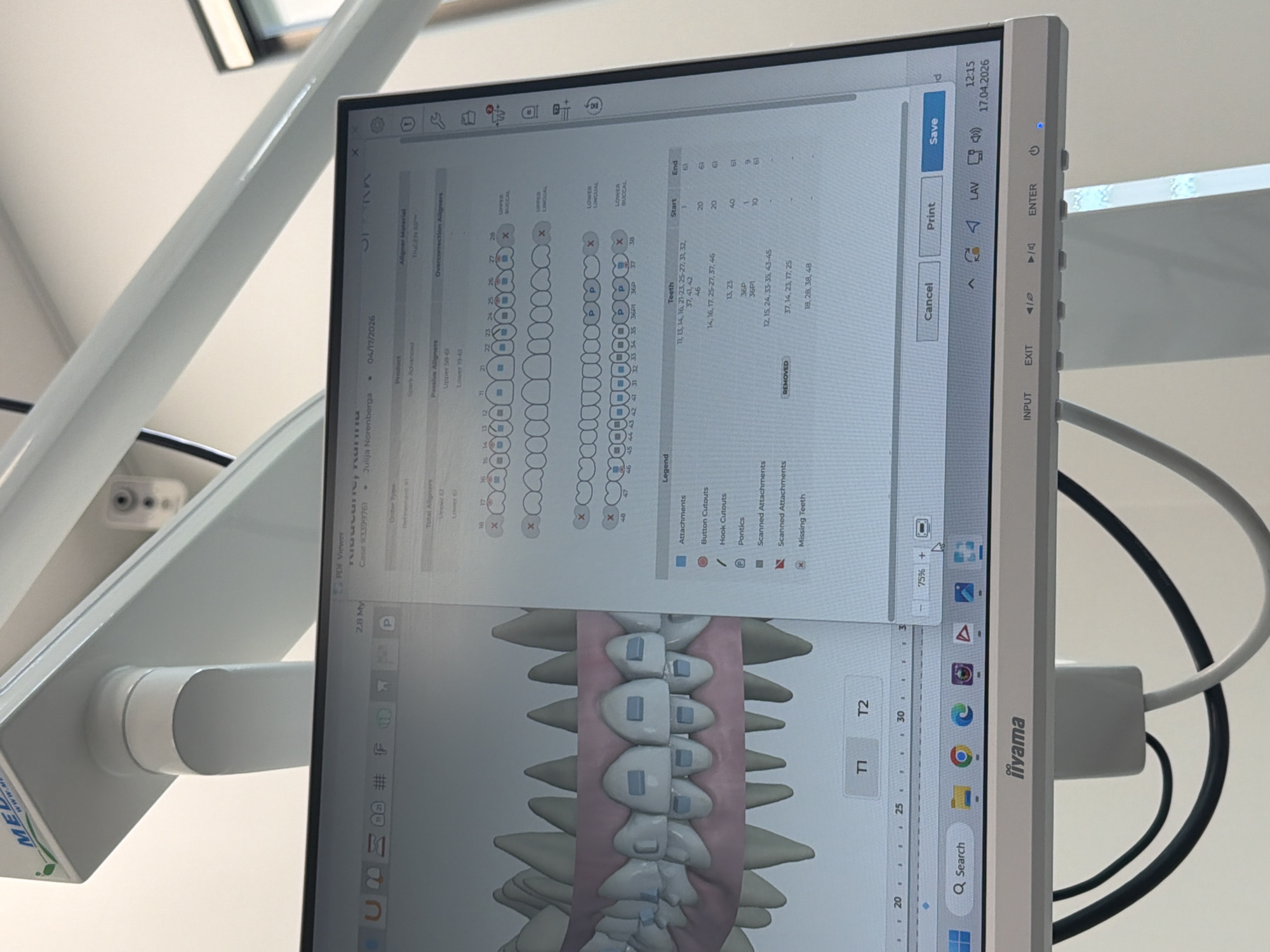 A dental office setting in Riga, Latvia is depicted, focusing on a monitor displaying specialized orthodontic planning software. The primary subject is an iiyama monitor mounted on a white, articulated dental equipment arm, with various cables visible behind it.
The monitor's screen shows a detailed digital model of a patient's lower and upper dental arches, illustrating teeth with attachments, likely for aligners or braces. A significant portion of the screen displays a chart detailing a treatment plan, including specific tooth numbers (e.g., 11-48), "Start" and "End" stages, and a "Legend" explaining icons for attachments, button cutouts, hook cutouts, pontics, scanned attachments, and missing teeth. Textual information like "Product: Spark Advanced," "Aligner Material: TruGEN X™," "Case #3399761," and "Julija Norenberga" (likely the patient's name) is visible. Other details include "Total Aligners Upper 58-61, Lower 19-61" and "Passive Aligners Upper 58-61, Lower 19-61". Navigation buttons such as "Save," "Print," and "Cancel" are present. The monitor's top right corner shows the time and date: "12:15, 17.04.2026." The Windows taskbar is visible at the bottom, featuring icons for Chrome, Edge, and a search bar. The monitor's physical control buttons are visible on the right side, including "INPUT," "EXIT," volume controls, "ENTER," and a power button. The dental equipment features a "MED" logo. The scene suggests an orthodontist or dental professional is reviewing or creating a patient's treatment plan.