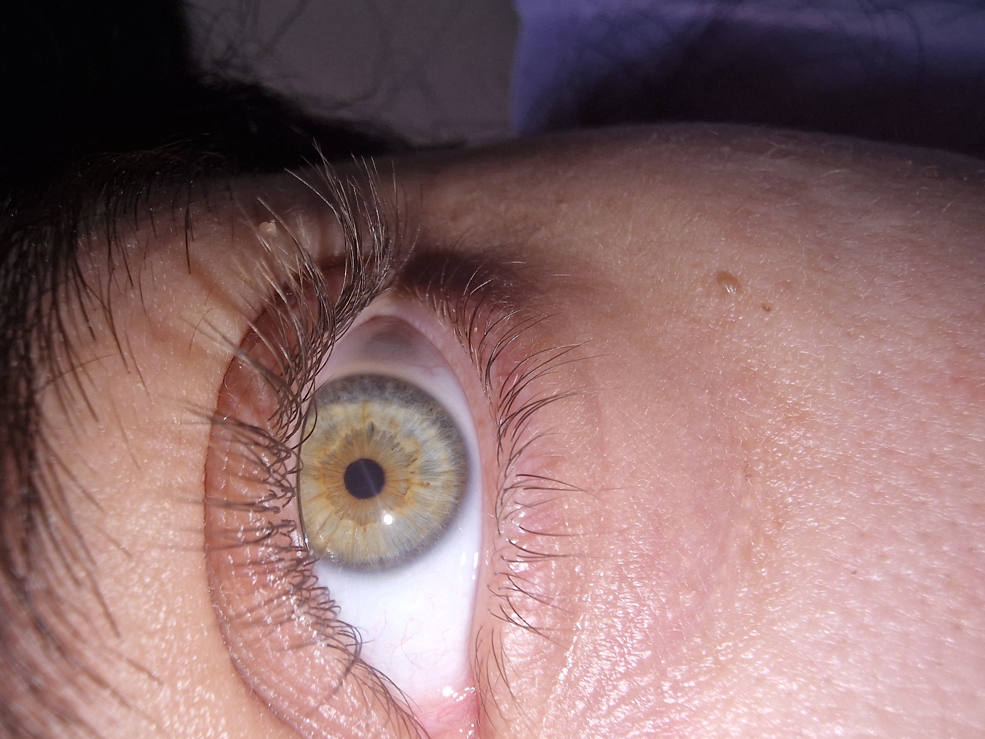 A high-resolution, close-up photograph captures a human eye looking upwards or to the side. The dominant feature is the iris, which displays a striking multi-toned color, appearing hazel or light green with warm brown tones near the dark, circular pupil, and a cooler, somewhat grayish-blue hue towards its outer edge. Bright reflections are visible on the surface of the pupil and iris, suggesting a direct light source.
Long, dark eyelashes frame both the upper and lower eyelids, showing fine detail and individual strands. Small, light-colored specks, possibly dust or dried secretions, are visible on some eyelashes and along the eyelid margins. The skin surrounding the eye is rendered in considerable detail, revealing pores, fine lines, and subtle textural variations. Several small, raised bumps, consistent with minor skin imperfections or milia, are noticeable on the upper eyelid and the skin above the eye in the cropped views. Dark hair, likely from eyebrows or the hairline, is visible on the left and top edges of the frame, providing context for the eye's position on a face. The image is tightly framed, offering an intimate and detailed view of the eye area without any broader environmental cues or discernible activity. No text is visible in the image.