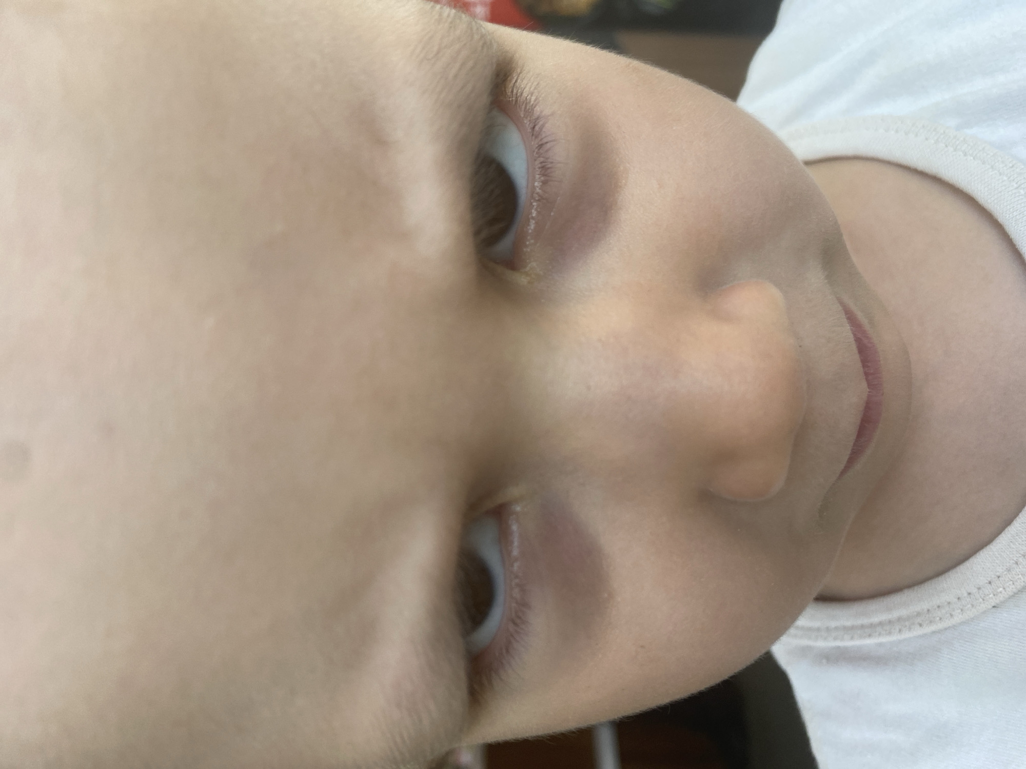 A close-up, slightly out-of-focus image shows the face of a young child with fair skin. The child's eyes are open and brown, and their nose and mouth are visible. A white garment, possibly a t-shirt, is visible on the right side of the image. The location is not discernible.