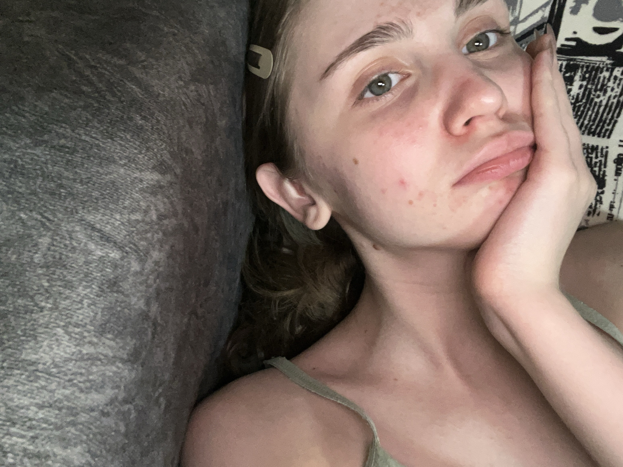 A young Caucasian woman with fair skin, green eyes, and light brown hair is lying on her side, propped up by her hand. She is wearing a light green tank top. Her hair is slightly messy and a light brown clip is visible in it. The background appears to be a textured gray surface, possibly upholstery, and a patterned fabric, likely bedding. There are some blemishes on her face, including redness and small red spots. The lighting is soft and natural. There is no discernible connection to Ashkadar, Russia.