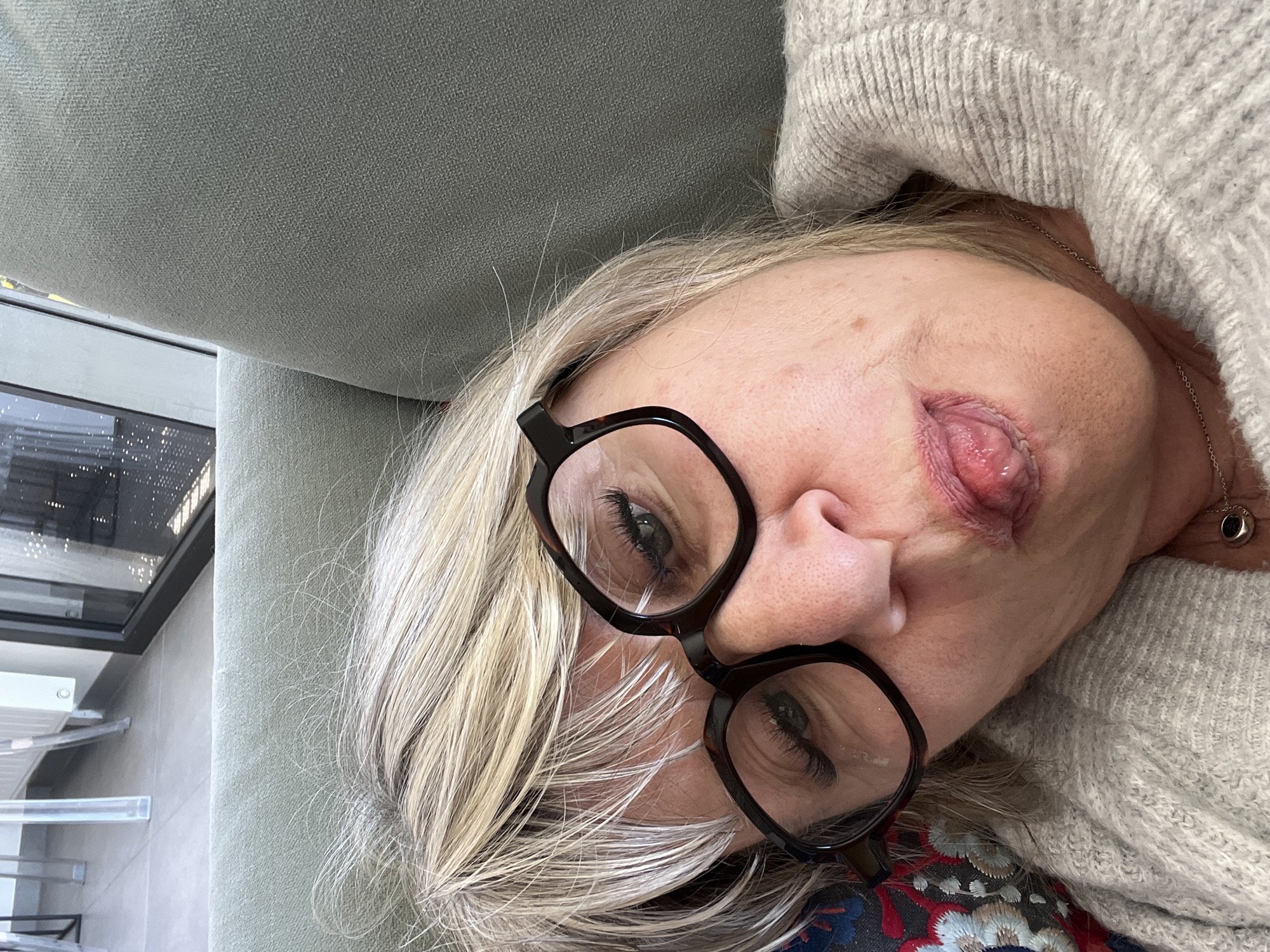 A woman with blonde hair and glasses is lying on a light green couch. She is wearing a grey sweater. There is a significant lesion on her right cheek. The location appears to be indoors. I am unable to verify the location as Chambœuf, France.