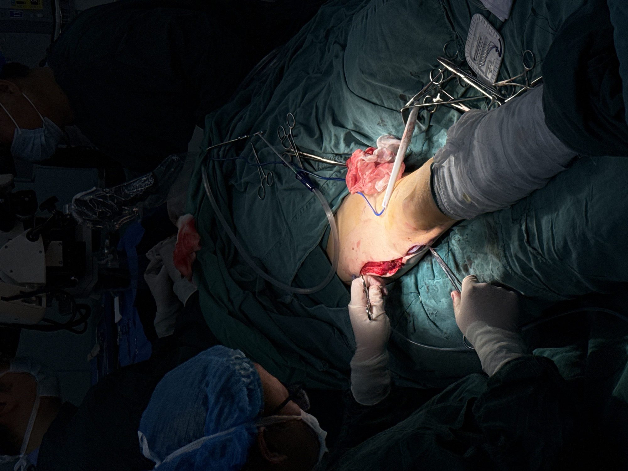 The image shows an ongoing surgical procedure in an operating room. The patient's leg is exposed, with a surgical incision visible. Sterile green surgical drapes surround the area. Multiple surgical instruments are present, including scissors and clamps. One gloved hand is holding surgical instruments, and another gloved hand appears to be manipulating tissue. A person in surgical garb, including a blue cap and mask, is visible in the lower-left corner. No definitive information is available to determine if the surgery is taking place in Yuzhong District, China.
