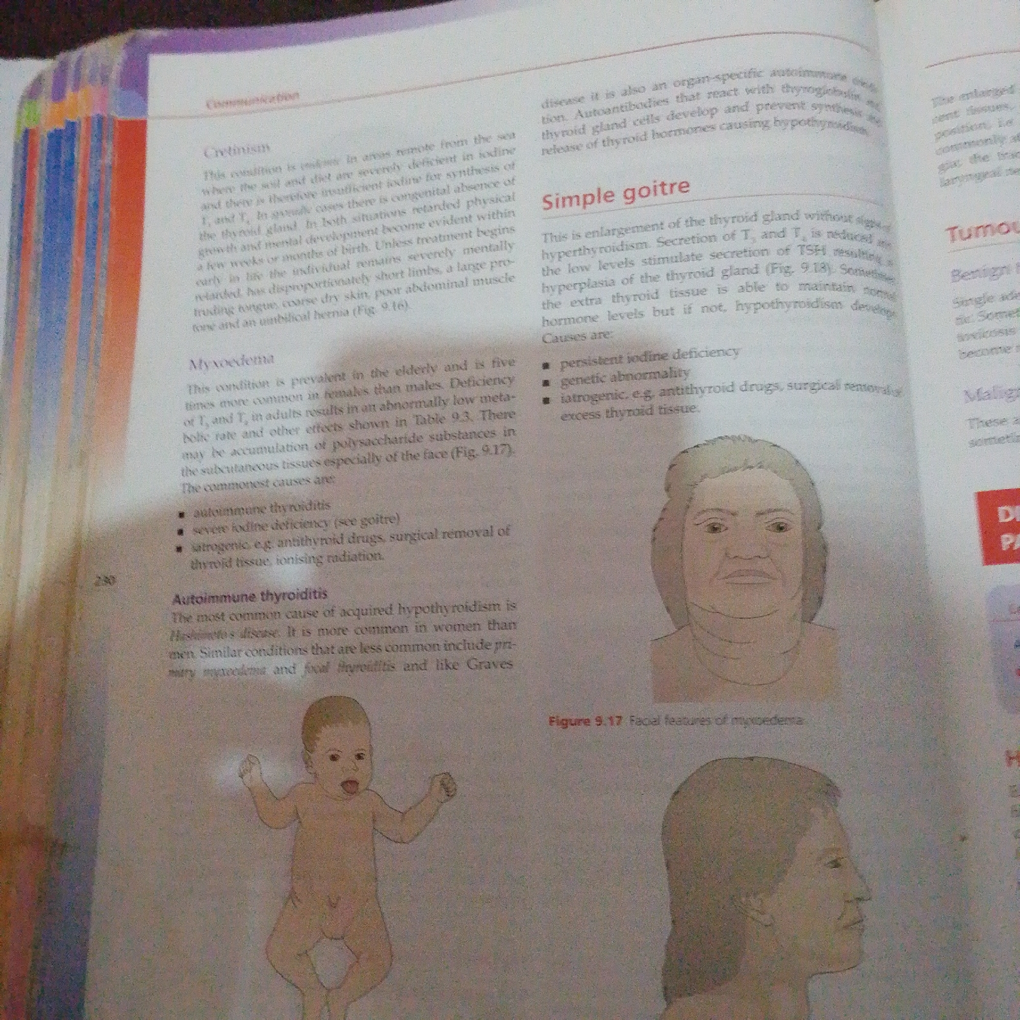 The image is a close-up, slightly angled shot of an open book, likely a textbook, displaying information about medical conditions related to the thyroid gland. The left side of the page details "Cretinism" and "Myxoedema," with bullet points listing causes for the latter. The right side of the page discusses "Simple Goitre," its causes, and includes a reference to "Figure 9.17 Facial features of myxoedema," accompanied by an illustration of a face. Below "Simple Goitre" are headings for "Tumours," "Benign," and "Malign." The page is primarily text-heavy, with some illustrations. There is no indication of the time of day, weather, or specific location beyond the context of the textbook's content. The tone is educational and informative. A small illustration of a baby is also visible on the left side of the page, below the text describing Cretinism.