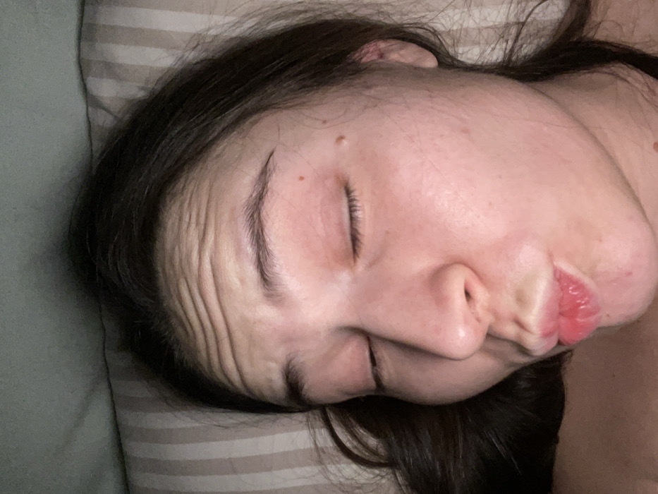 A woman with dark hair lies on a striped pillow. Her eyes are closed, and her face is turned to the side, showing prominent forehead wrinkles. Her lips are slightly puckered. Moles are visible on her forehead and cheek.