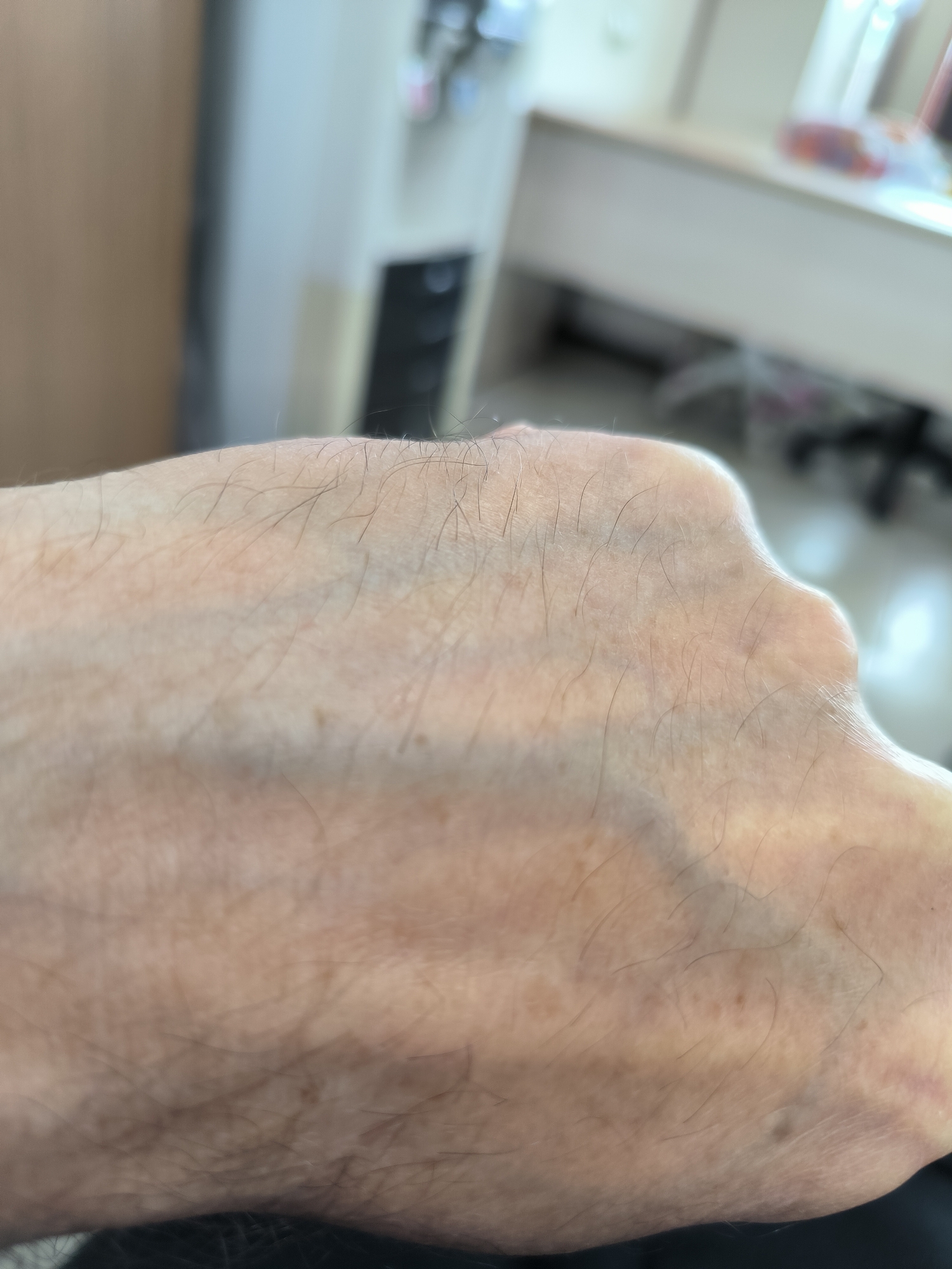 The image shows a close-up of a person's forearm or wrist, with visible veins and fine hairs. The skin appears to be light-toned with some areas of slight discoloration. The background is out of focus and appears to be an indoor setting, possibly an office or waiting room, with a desk and chair visible. There is no information to suggest this image is located in Yuzhno-Sakhalinsk, Russia, or any specific city.