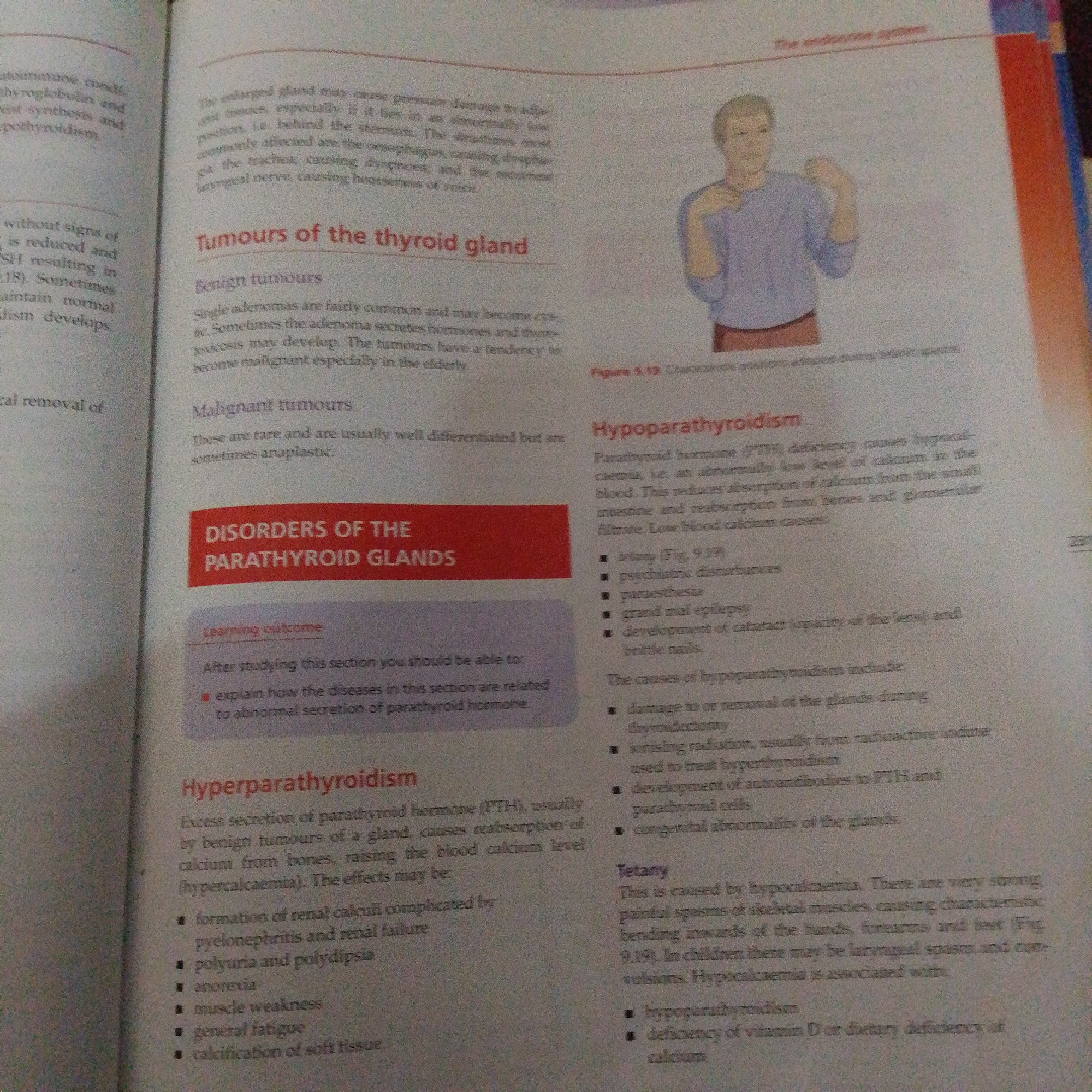 This media file is a close-up, slightly blurry photograph of an open textbook. The image shows two pages of text and an illustration.
The left page discusses "Tumours of the thyroid gland" and "Malignant tumours," with a section titled "DISORDERS OF THE PARATHYROID GLANDS" highlighted in a red box. This section includes a "Learning outcome" that explains the section's focus on abnormal parathyroid hormone secretion. Below this, it details "Hyperparathyroidism," listing its causes and effects, such as the formation of kidney stones and muscle weakness.
The right page features a title, "Hypoparathyroidism," and explains its causes, including a deficiency in parathyroid hormone leading to low blood calcium levels. It lists symptoms like psychiatric disturbances, epilepsy, and brittle nails. The text also mentions the causes of hypoparathyroidism, such as damage during thyroidectomy or radiation. A sub-section titled "Tetany" describes spasms caused by hypocalcemia.
An illustration on the right page depicts a simplified, full-body drawing of a person with their arms positioned outwards, hands slightly raised and palms facing upwards, and shoulders hunched. This figure is associated with the text above, likely illustrating a posture related to endocrine system function. The text above the illustration is partially obscured but appears to be a caption or title related to the endocrine system.
Visible text includes section titles, bullet points detailing symptoms and causes, and the illustration caption. The overall setting is a book or educational material, suggesting an academic or study context. No specific time of day, weather, or emotions are discernible from the image. The location context provided (Jalingo, Nigeria) cannot be visually confirmed from the image itself.