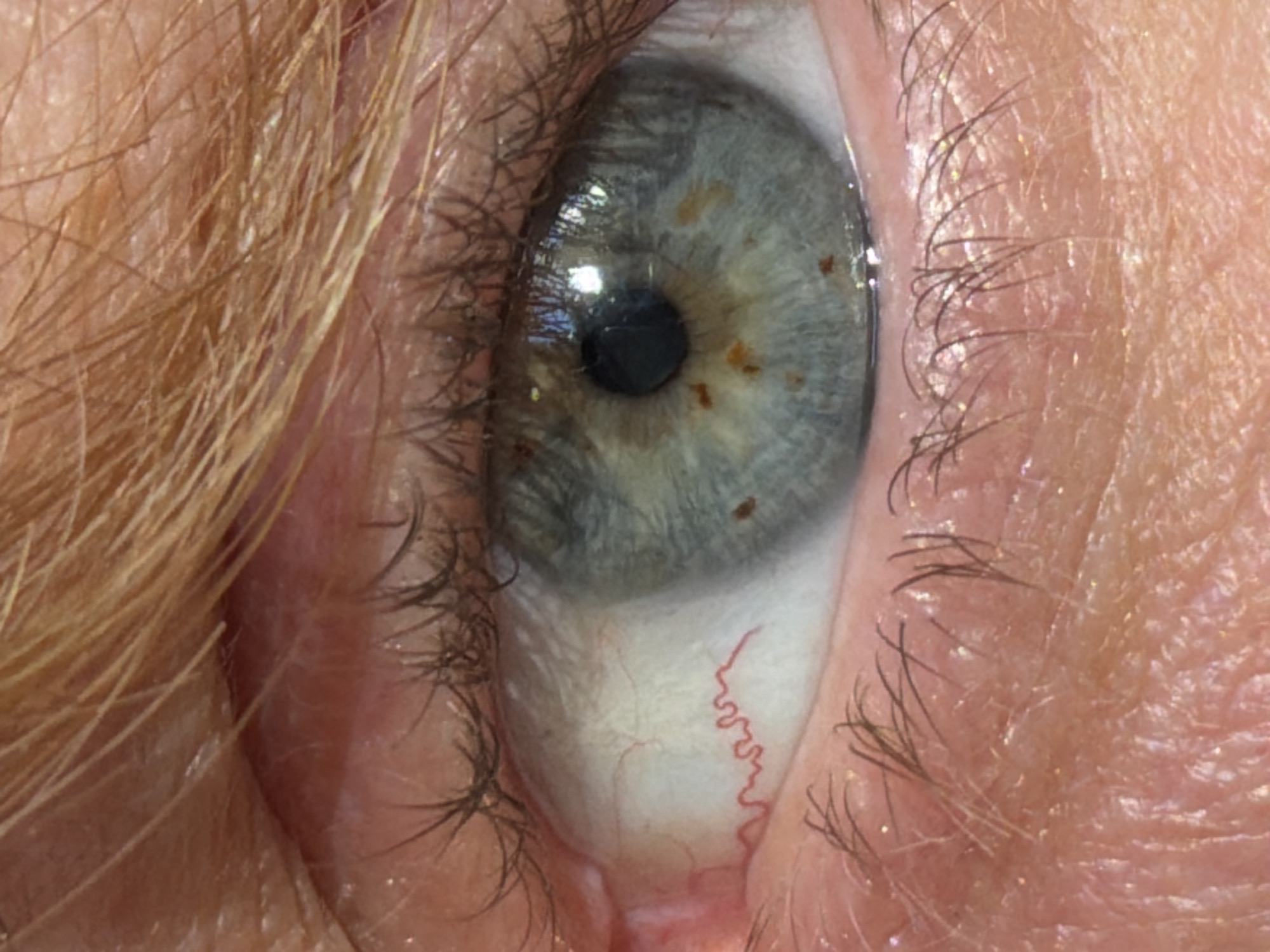 This is a close-up, macro photograph of a human eye. The iris is a pale blue-green with visible brown flecks and a dark pupil. There are several small, reddish-brown spots scattered across the iris. The sclera (the white part of the eye) is visible, with some red blood vessels. The eyelids are lined with eyelashes, and the surrounding skin shows texture and fine hairs. The image does not contain any elements that would allow for determination of its location in Sofia, Bulgaria, or any environmental context.