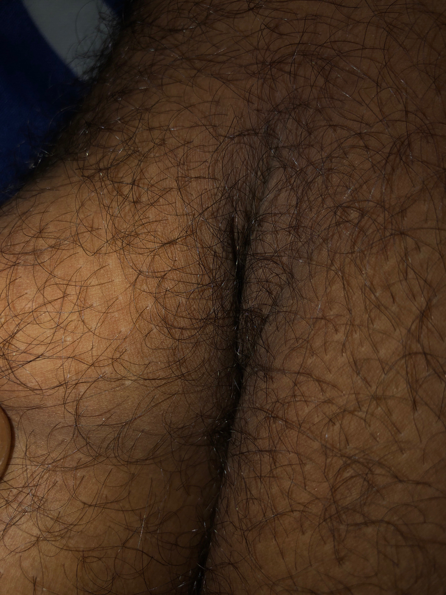 The image shows a close-up view of a person's skin with dark, curly hair. The skin appears to be tanned or medium-toned. The lighting is somewhat dim, casting soft shadows and highlighting the texture of the skin and hair. There are no discernible objects or specific scene elements visible, suggesting the focus is entirely on the anatomical detail. The image is static and does not depict any activity or event. There is no visible text. The location context provided is Birgunj, Nepal, but this cannot be inferred from the image itself.