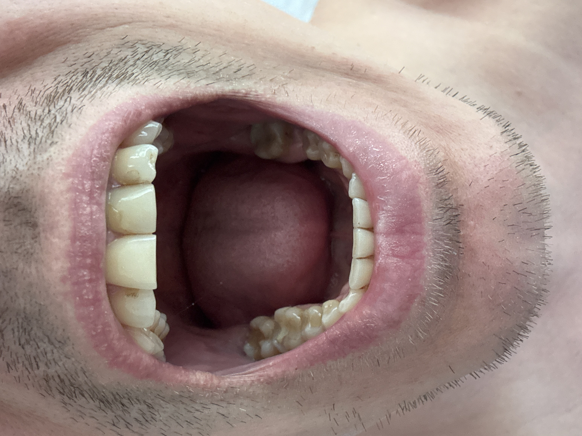 A close-up photograph depicts an open human mouth. Visible are the teeth, tongue, and the surrounding facial hair. The location of the image is indeterminable.