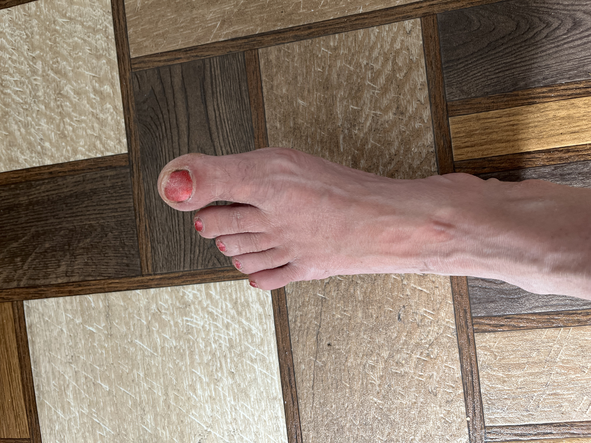 The image displays a close-up view of a person's left foot resting on a floor with a wood-grain tile pattern. The foot has painted toenails, with the big toenail appearing red and slightly damaged or inflamed. The skin on the foot exhibits some dryness and faint lines. The floor is composed of rectangular tiles in varying shades of brown and beige, arranged in a grid. There is no visible indication of the location being in Zhigalovo, Russia.