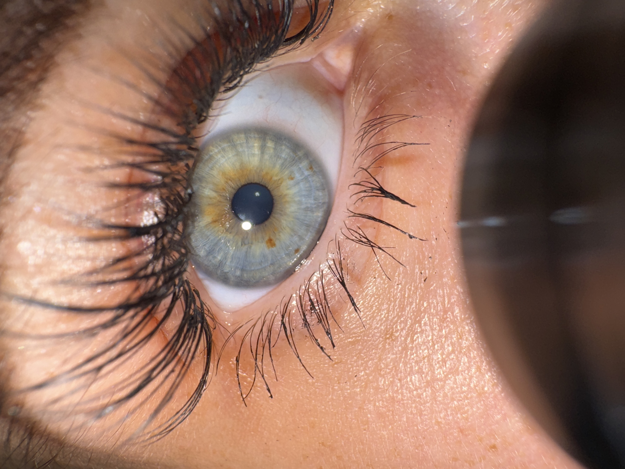 This is a highly magnified, close-up photograph of a human eye. The central subject is the eye, specifically the iris, pupil, and surrounding skin and eyelashes.
The iris presents a complex and striking color, predominantly light blue-grey with a distinct ring of golden or amber pigmentation closer to the dark, centrally placed pupil. Scattered small brown flecks are also visible within the iris. The pupil itself is dark and circular, reflecting multiple light sources, suggesting bright, direct illumination, possibly from a ring light or specialized examination lamp. The white sclera is visible around the iris, showing some fine, normal red blood vessels.
Long, dark eyelashes frame the eye, appearing to be coated with mascara, particularly on the upper lid, with some slight clumping evident. The lower eyelashes are also prominent. The skin around the eye shows fine texture, including visible pores and subtle lines, highlighting the extreme close-up nature of the shot. A large, dark, out-of-focus object partially obscures the right side of the frame, likely a part of a camera lens or an ophthalmological instrument used for the examination.
The overall scene suggests a detailed photographic study or medical examination of the eye. There are no visible location cues within the image, nor discernible time of day, weather conditions, emotions, or any text. The context places this scene in Chaikovsky, Russia.