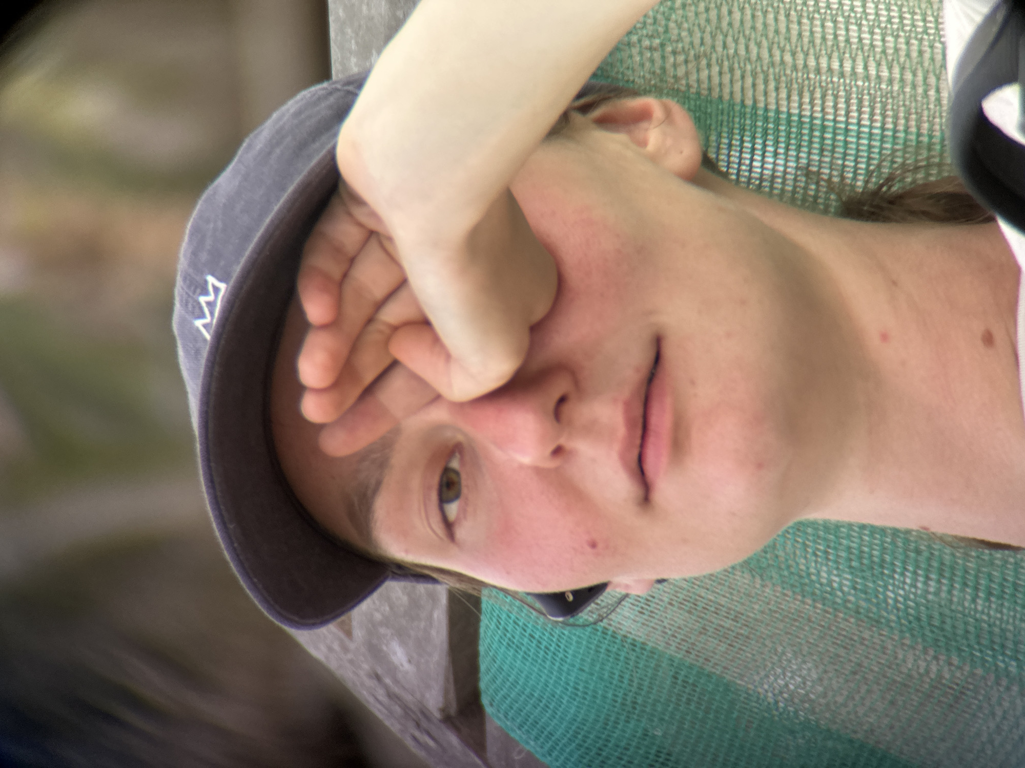 The image shows a close-up, shoulder-level, outdoor portrait of a person wearing a dark baseball cap with a white crown emblem. The person's right hand is covering their right eye, with the fingers partially obscuring the forehead and nose. The person's left eye is visible and is light brown. They have fair skin with some redness and freckles on their cheeks and nose. Their mouth is slightly open, and they appear to be looking towards the camera. A small mole is visible on their left cheek. They are wearing what appears to be a white t-shirt. The background is blurred but suggests an outdoor setting with some greenery and possibly a wooden structure. A green mesh-like material is partially visible to the left of the person. No specific landmarks or indicators place this image within the city of Đà Nẵng, Vietnam.