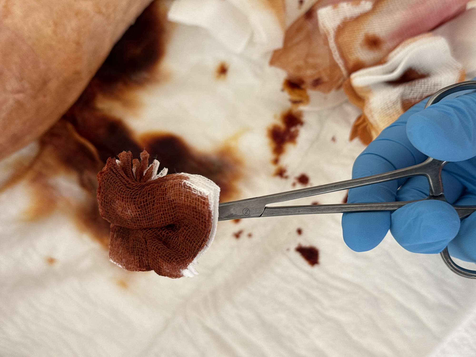 A close-up, overhead shot shows a gloved hand holding surgical scissors that grip a blood-soaked gauze pad. The gauze is brown and appears to be saturated with blood. The background consists of white cloth, also stained with blood. There is a portion of a person's arm visible in the upper right corner. The scene is sterile and clinical, suggesting a medical procedure is in progress. The location in Pleven, Bulgaria, is not discernible from the image itself.