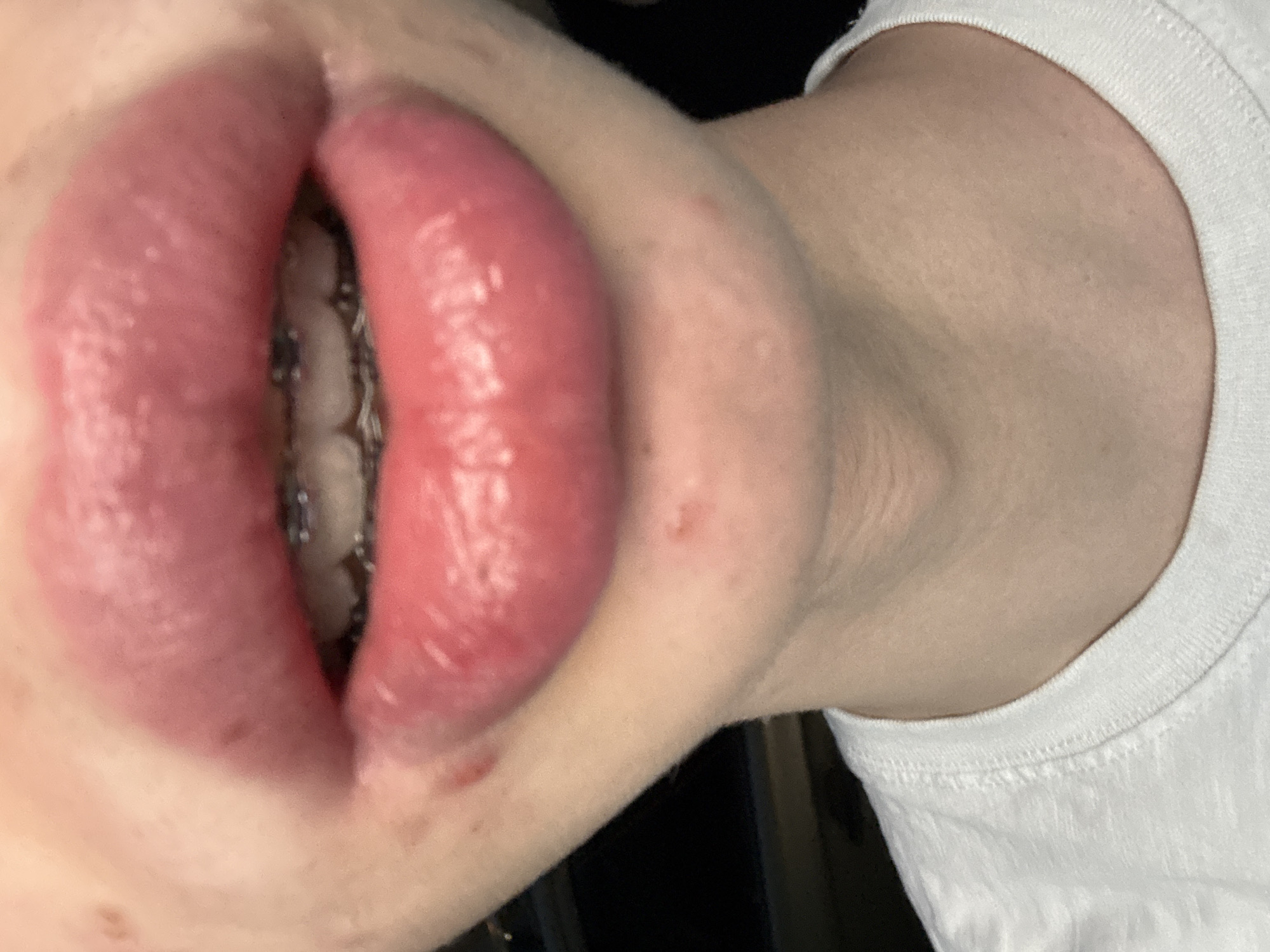 A close-up, head-on shot shows a person's mouth and chin. The mouth is open, revealing metal braces on the teeth. The lips are full and glossy, with a pinkish-red hue, and appear to have a slight shine to them. A few small reddish bumps or blemishes are visible on the skin around the mouth and chin. The person is wearing a white t-shirt, the collar of which is visible at the bottom of the frame. The background is dark and out of focus. The image does not contain information about location in the city of Unknown, Unknown.