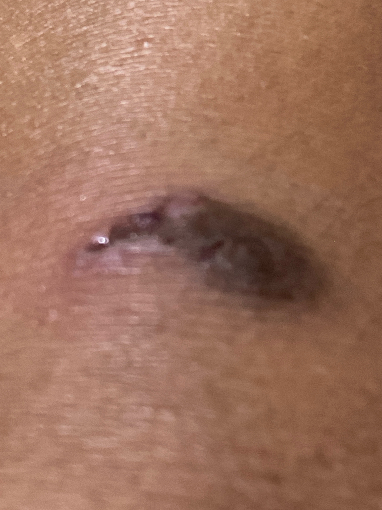 The image shows a close-up of skin with a raised, dark lesion. The lesion is oval-shaped and appears to have some discoloration and texture variation. There is a small, lighter colored area to the left of the main lesion, which could be an opening or a different type of mark. The surrounding skin is a light brown color and shows some fine lines and pores. The lighting in the image creates some shadows and highlights on the skin and lesion. The image does not provide any information about the location in Batam, Indonesia, or any context beyond the close-up view of the skin.
